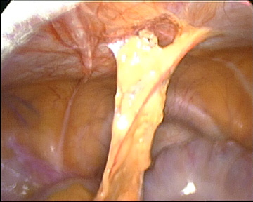 omental-adhesions omental-adhesions