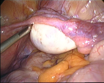 right ovary and tube right ovary and tube