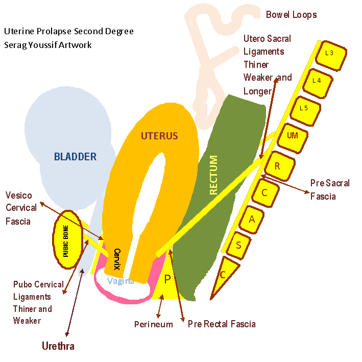 icd 10 code for second degree uterine prolapse