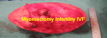 Myomectomy Infertility IVF