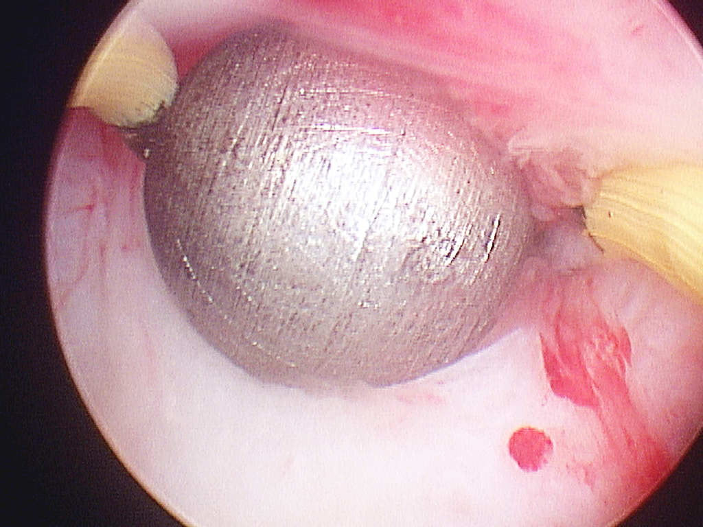roller ball endometrium before treatment roller ball endometrium before treatment
