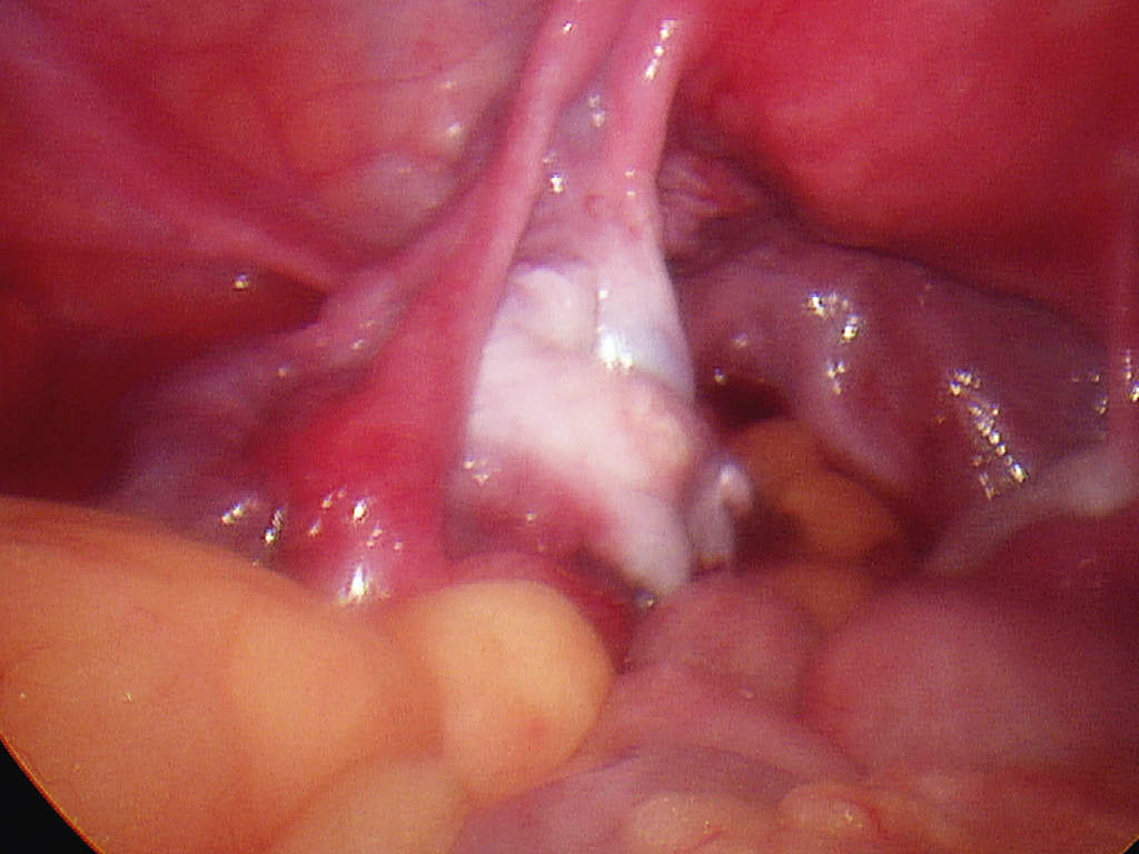 ovary-after-cyst-removal