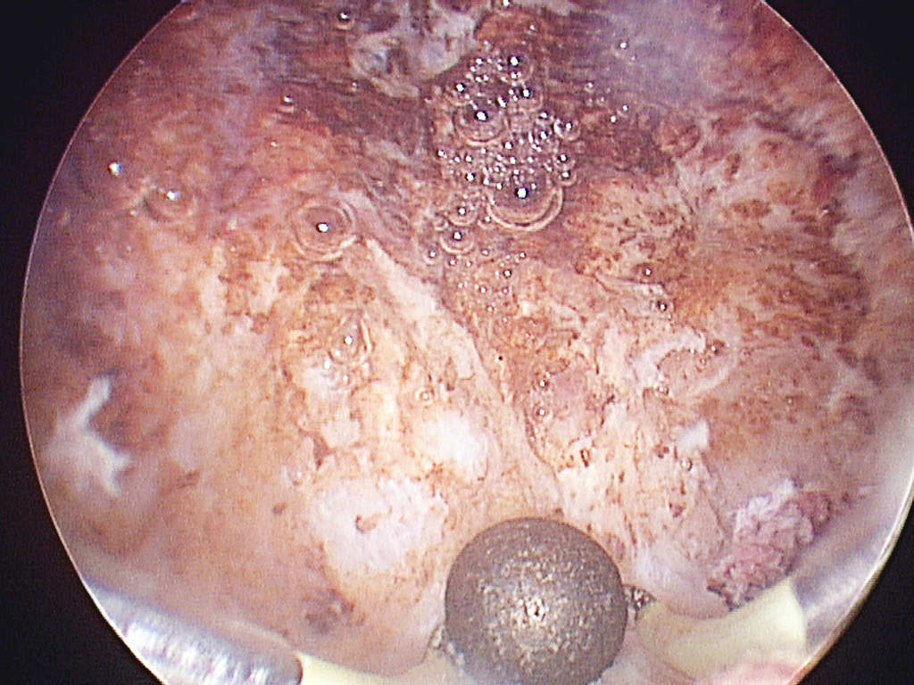 roller ball endometrium after treatment roller ball endometrium after treatment