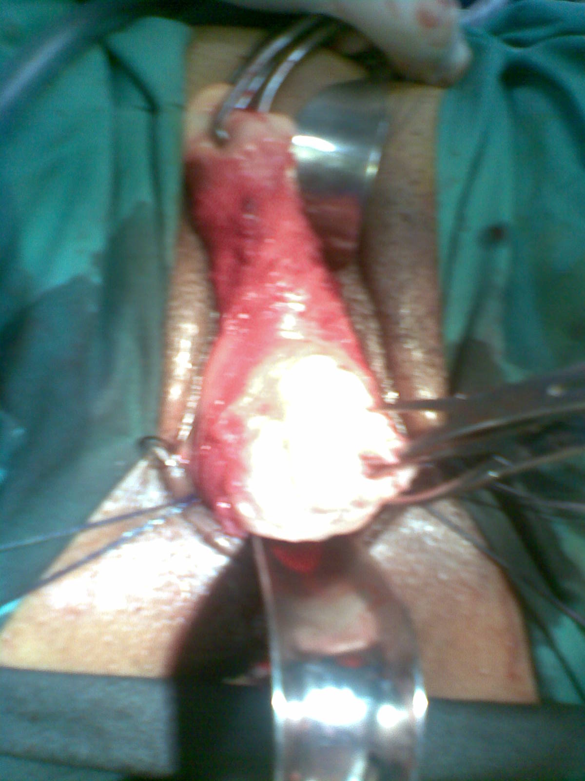 Hysterectomy Vaginal Youssif