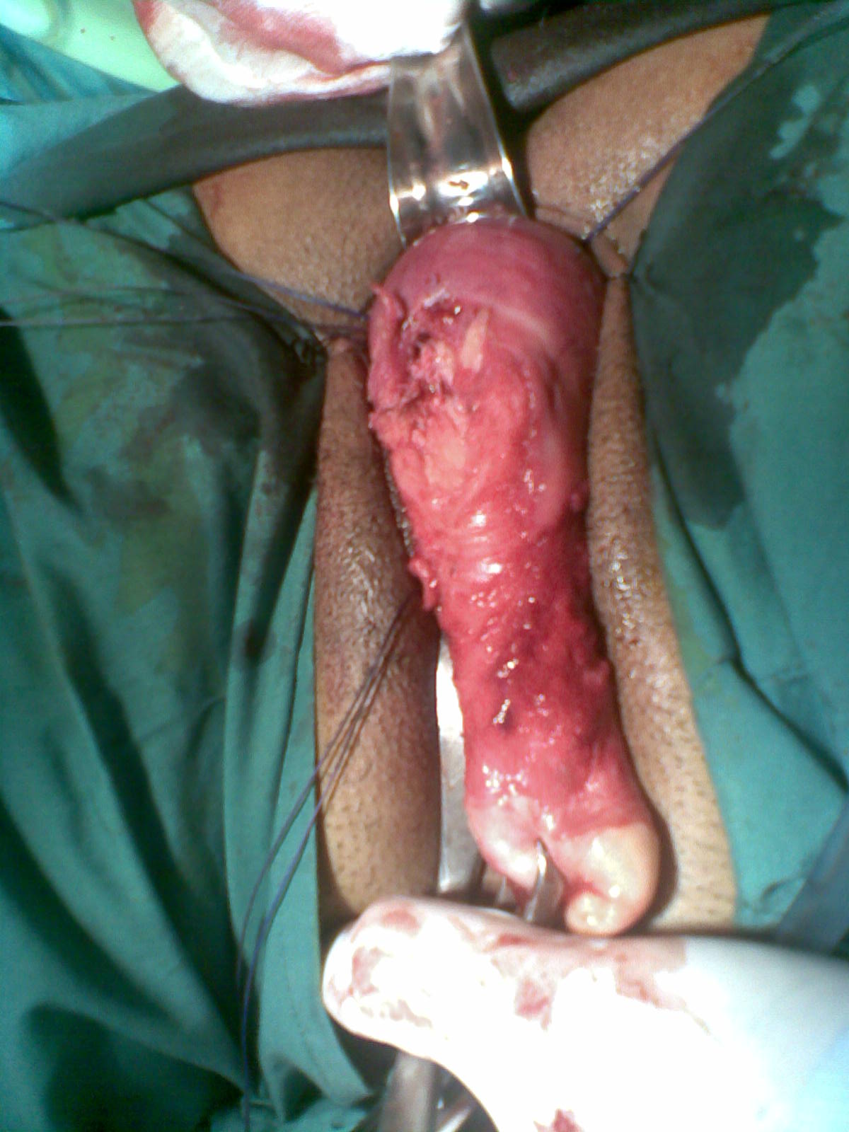 Fibroids Vaginal Hysterectomy Youssif