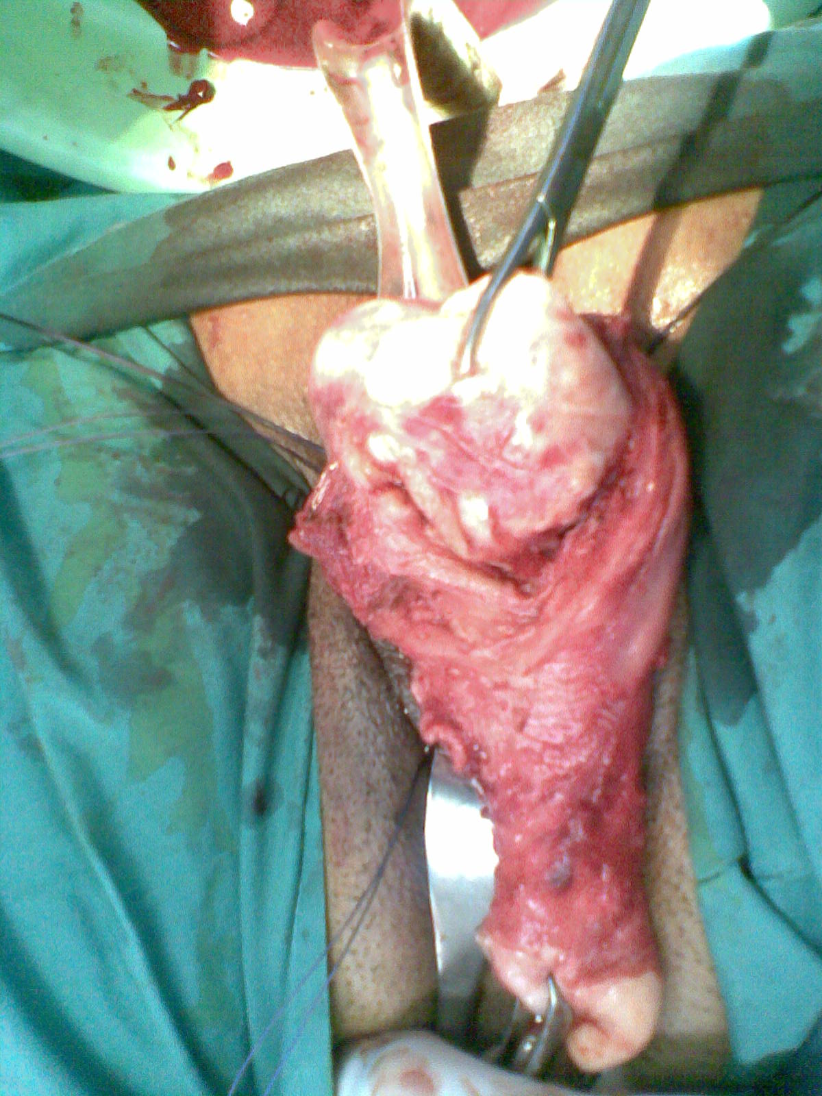 Myomectomy Vaginal Hysterectomy Youssif