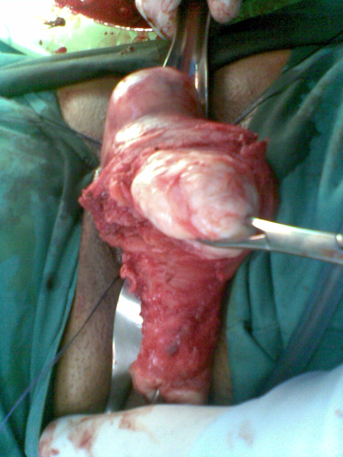  Vaginal Myomectomy Hysterectomy Youssif
