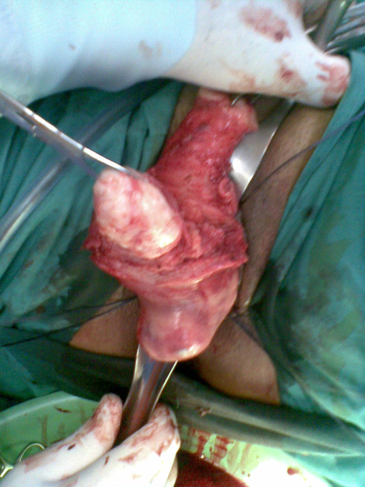 Hysterectomy Vaginal Myomectomy Youssif