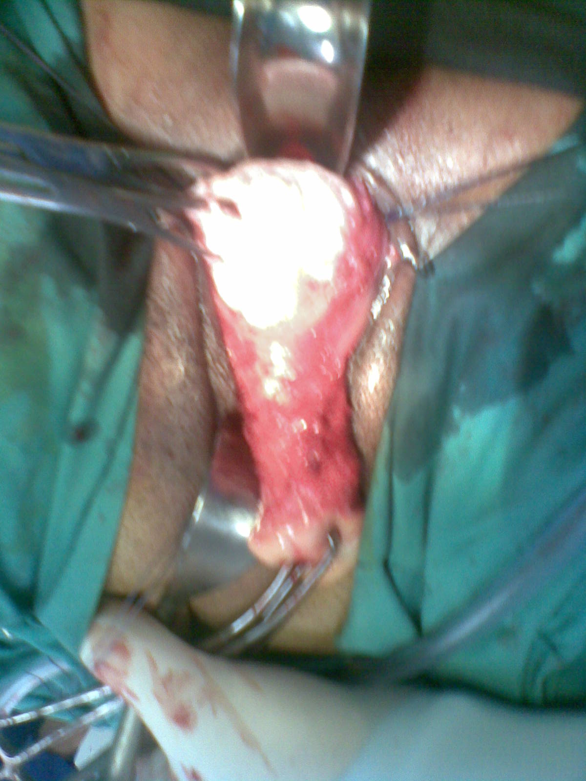 Vaginal Hysterectomy Youssif