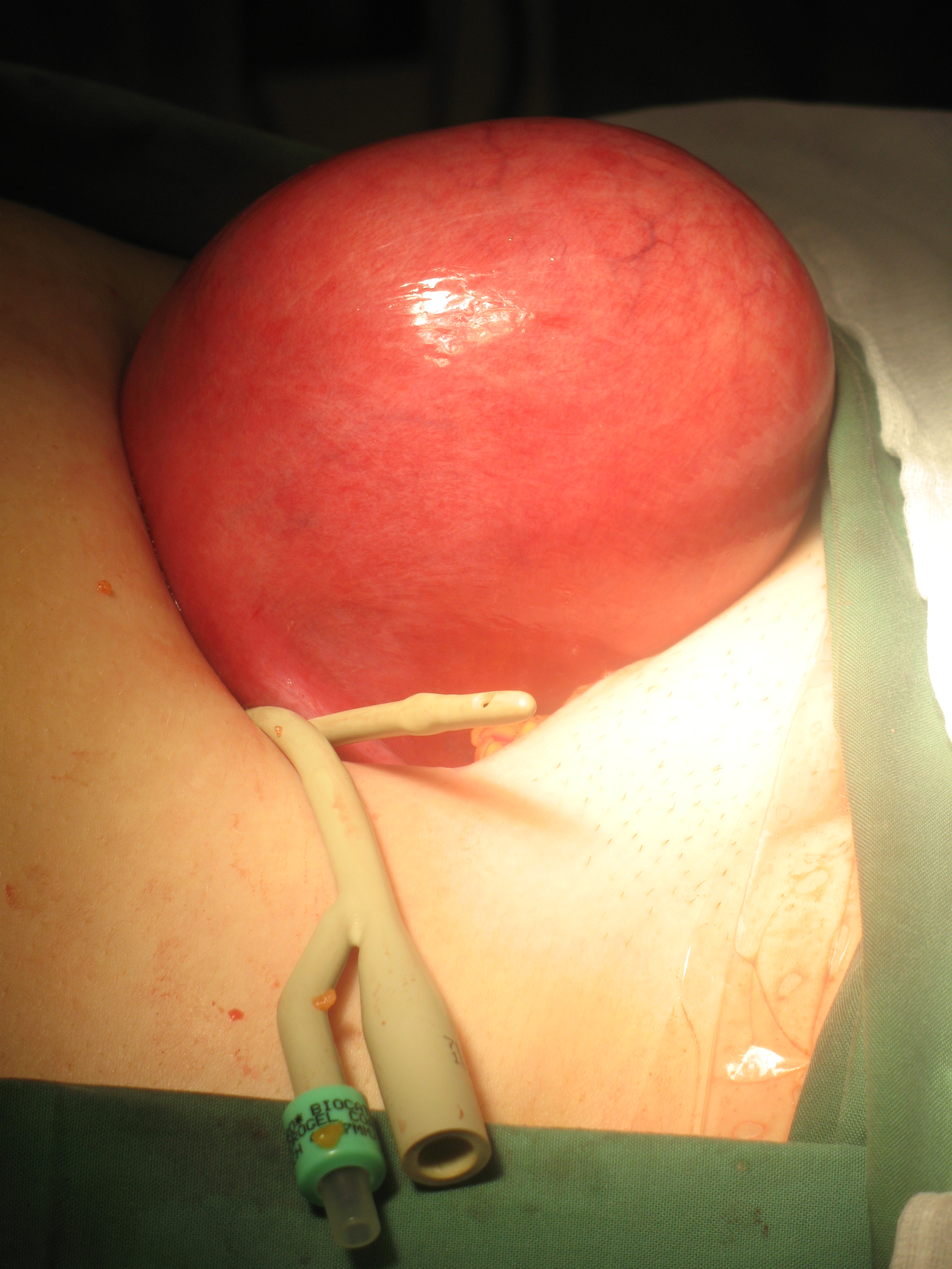 large-myoma-fibroid-intramural-abdominal-incision