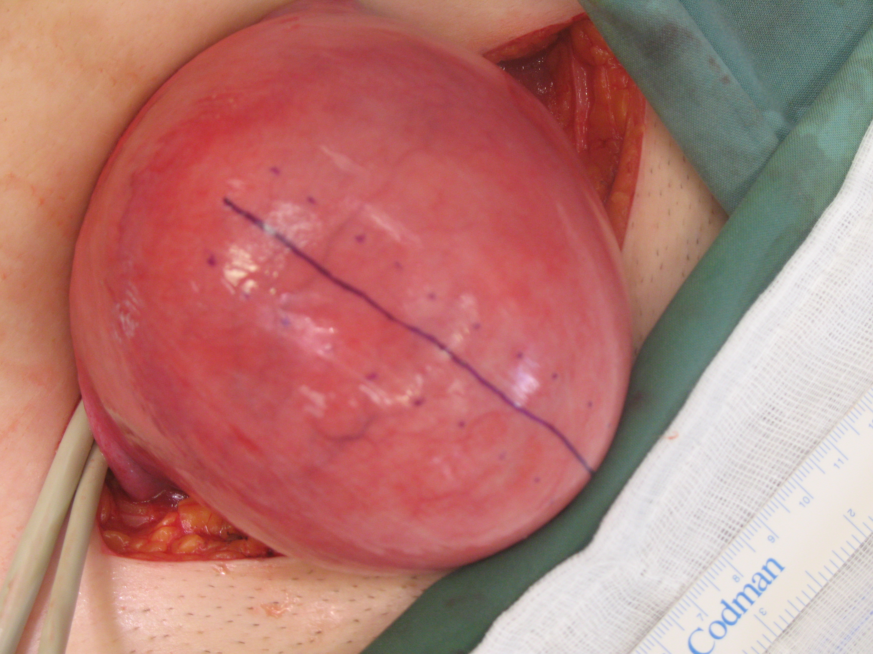 large-intramural-myoma-fibroid-11cm-marking-the-cut