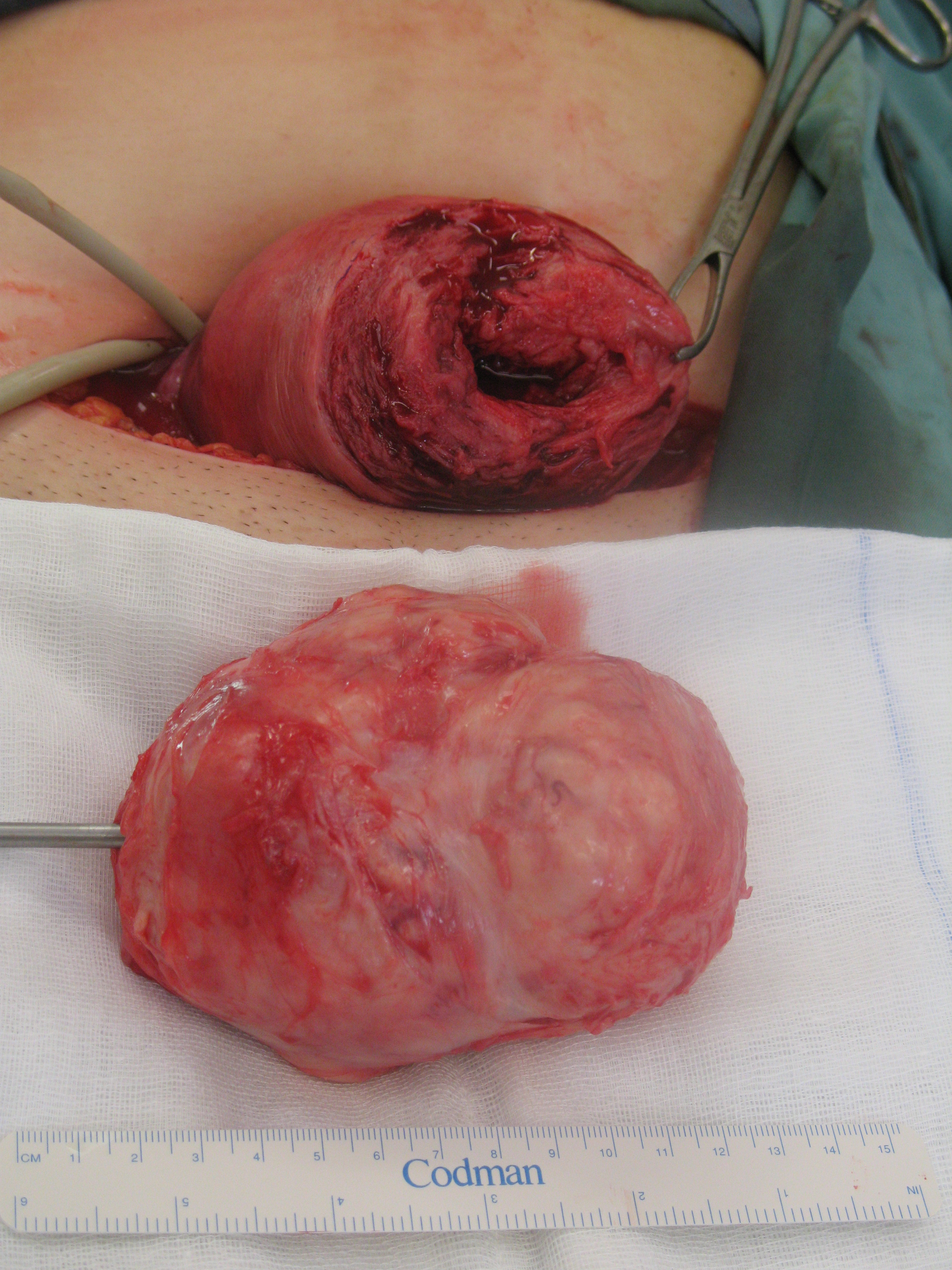11cm-fibroid-myoma