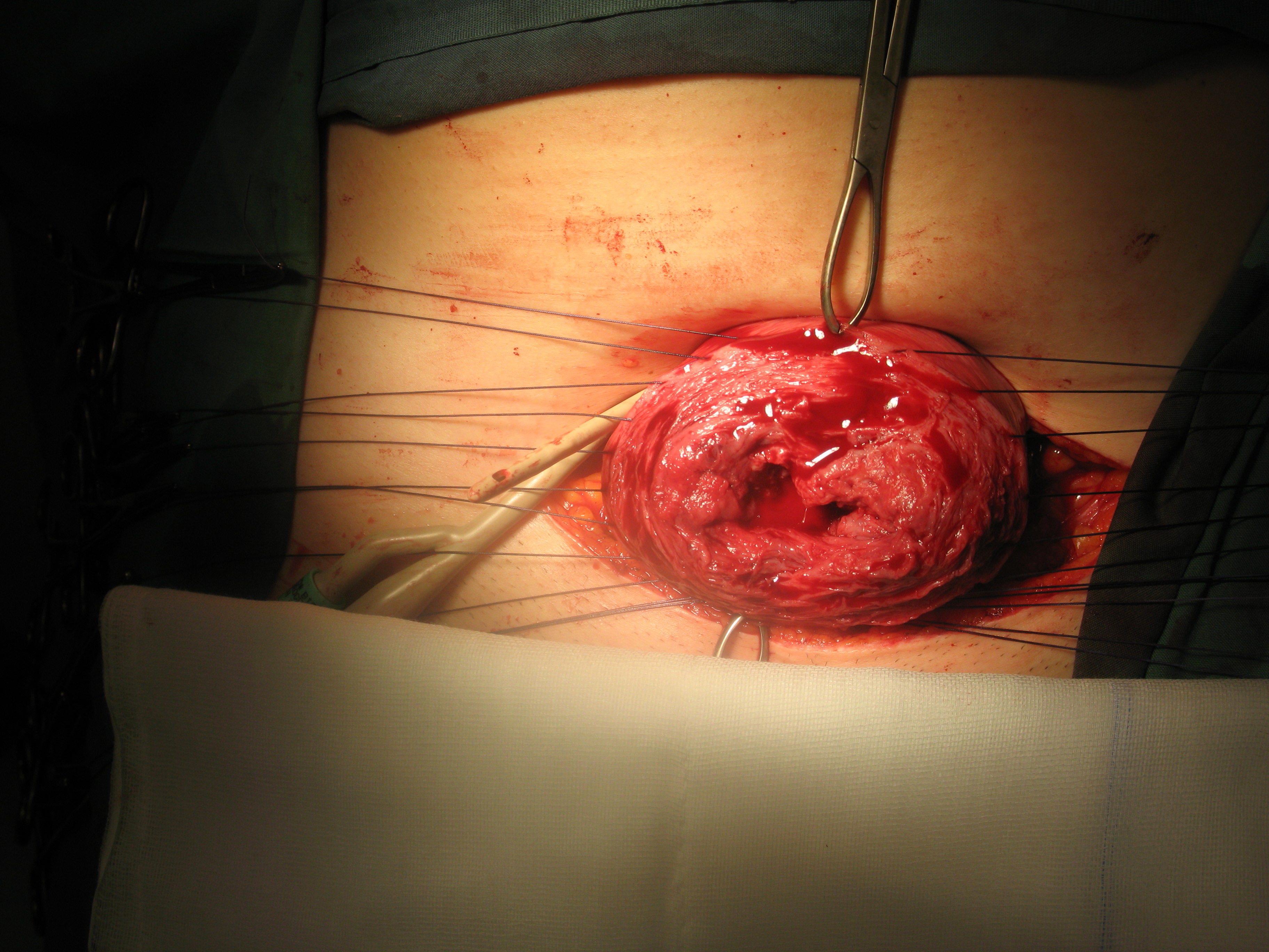 suturing-the-uterus-to-restore-uterine-wall-and-strength