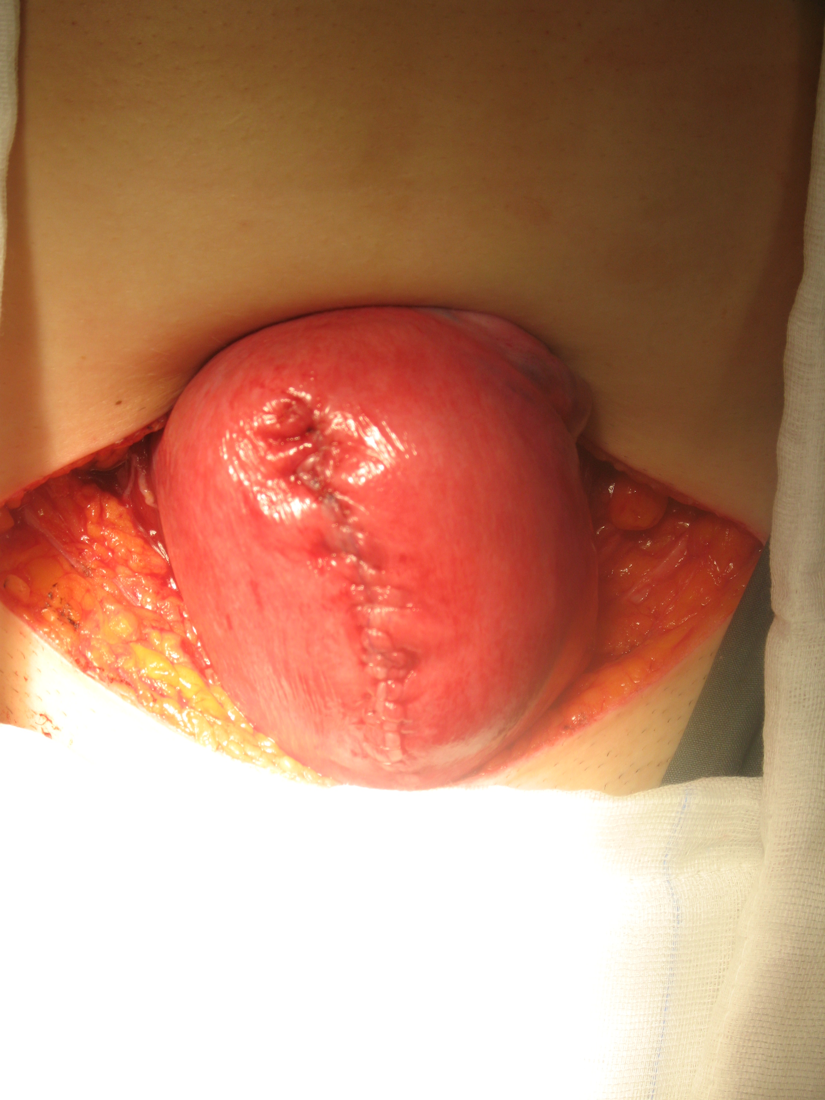sutured--uterus-restoring-shape.size