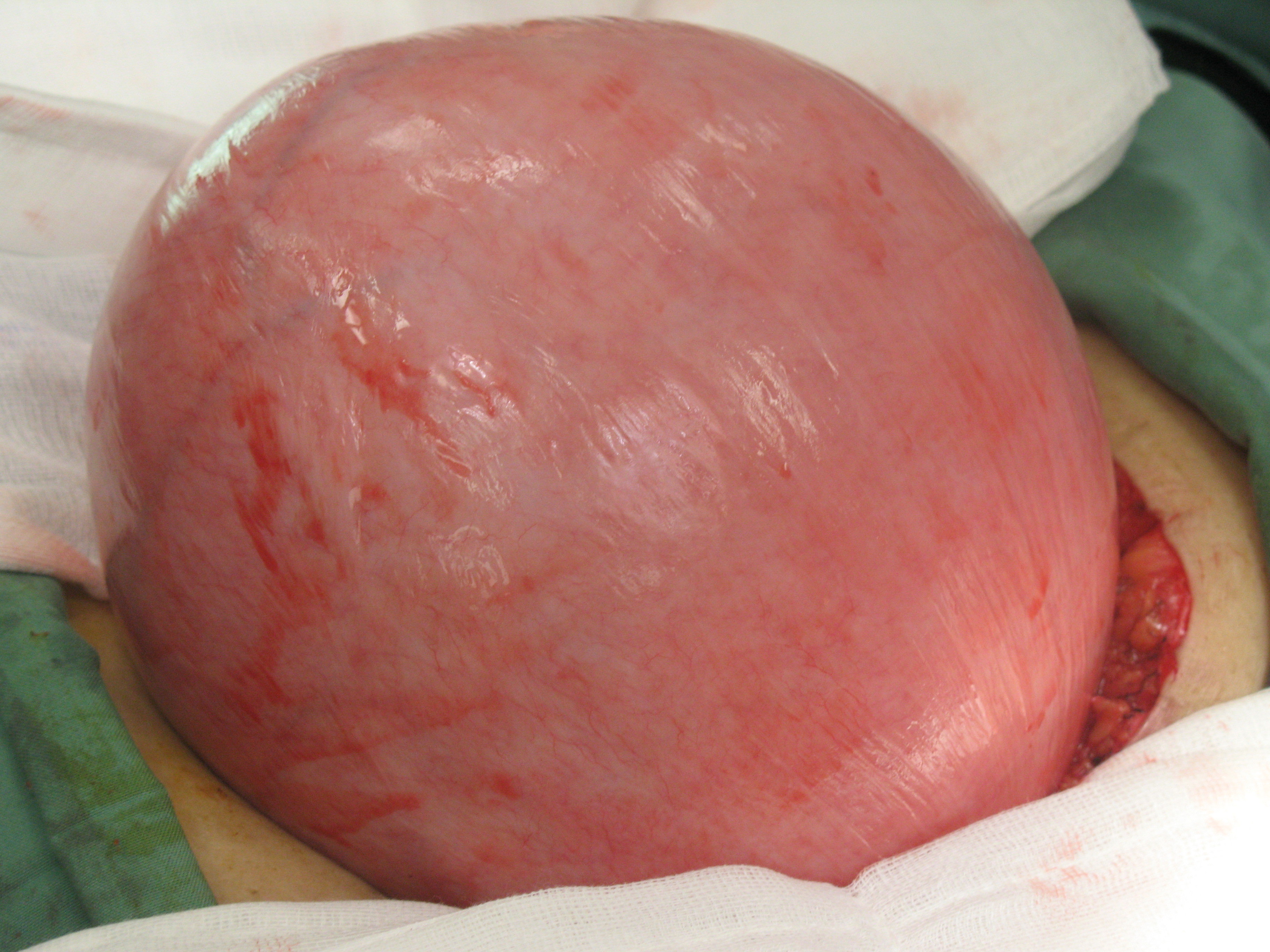 fibroid uterus serag youssif fibroid uterus serag youssif