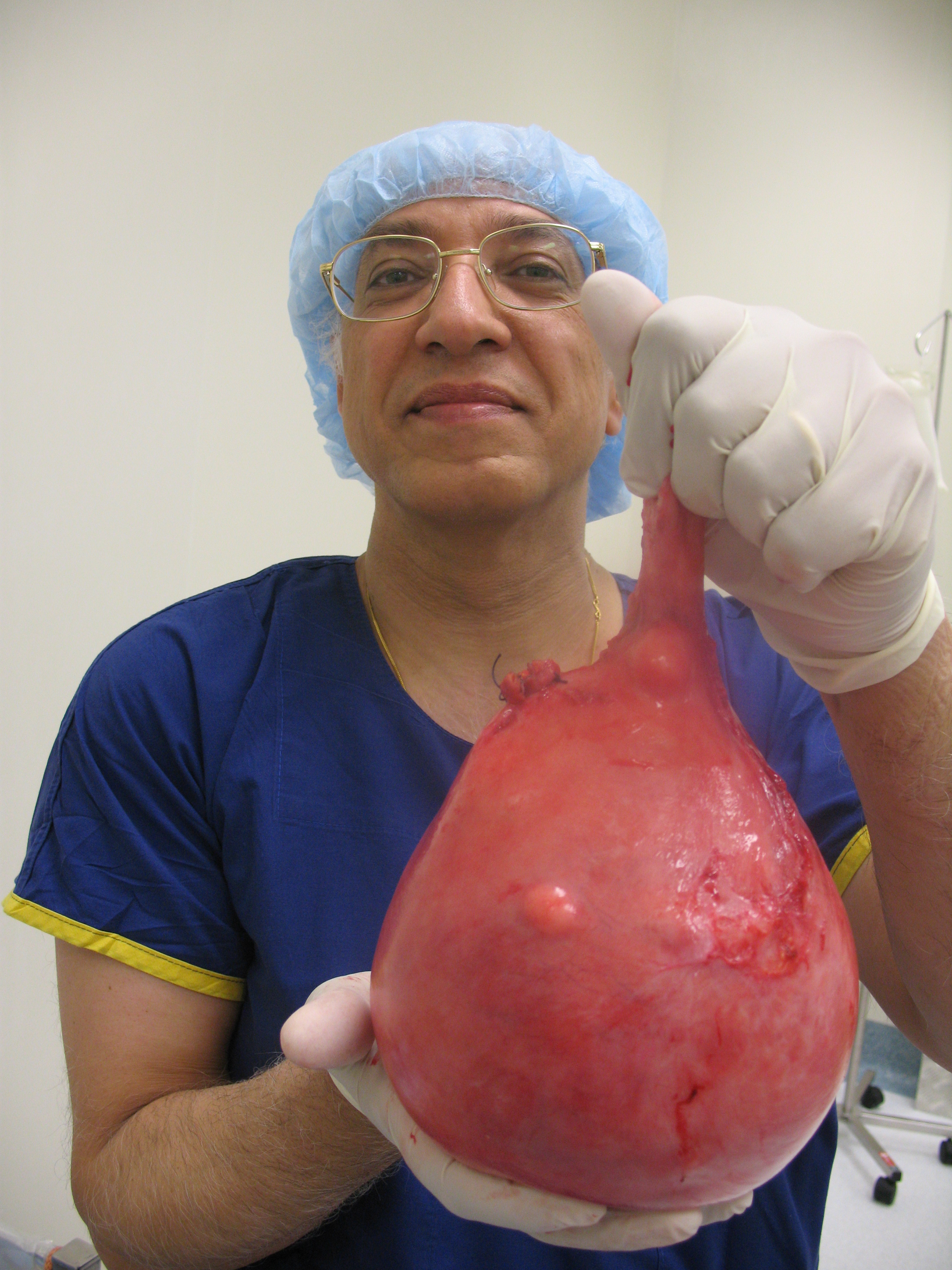 fibroid uterus serag youssif fibroid uterus serag youssif