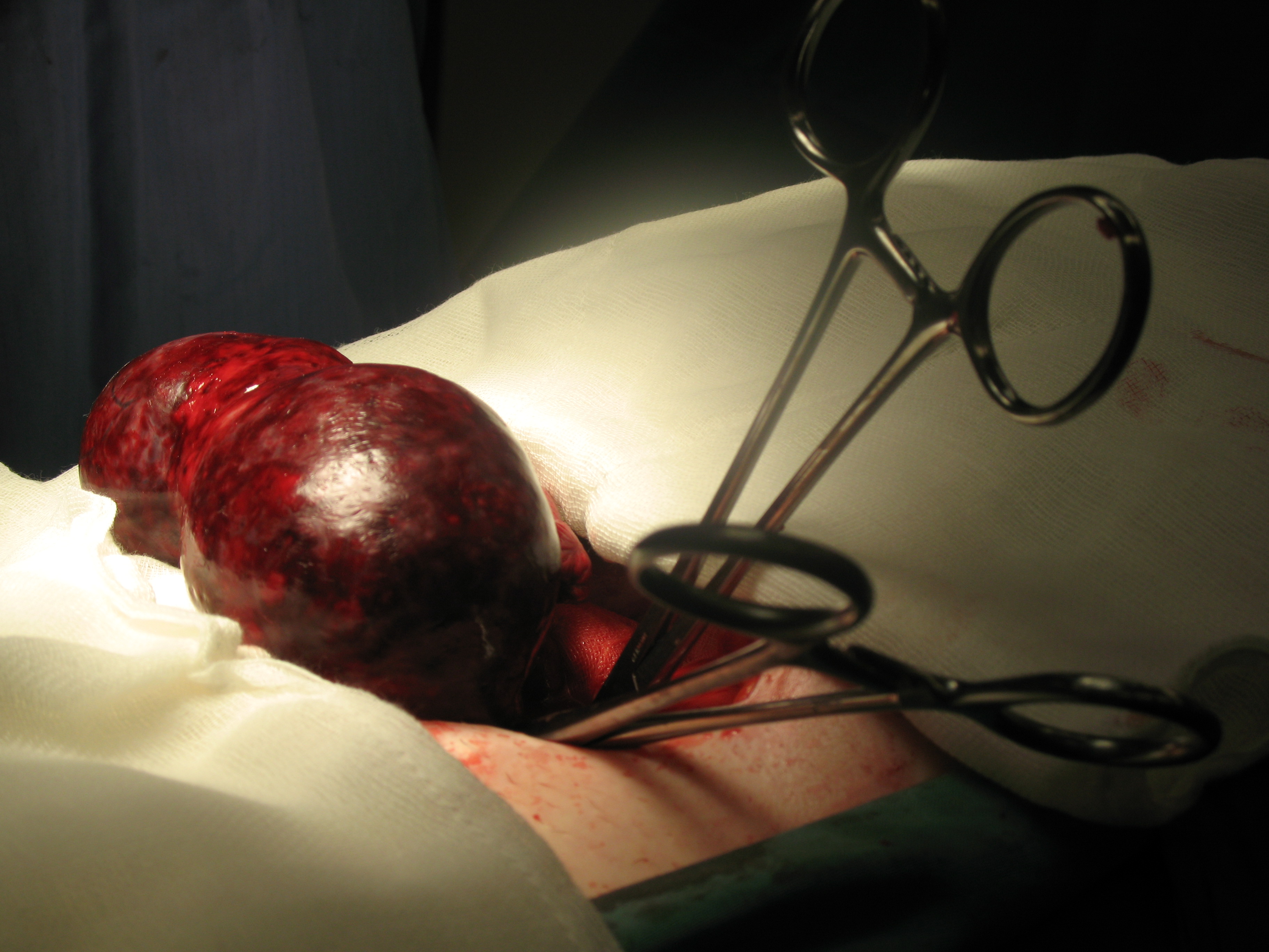 dermoid ovarian torsion youssif dermoid ovarian torsion youssif