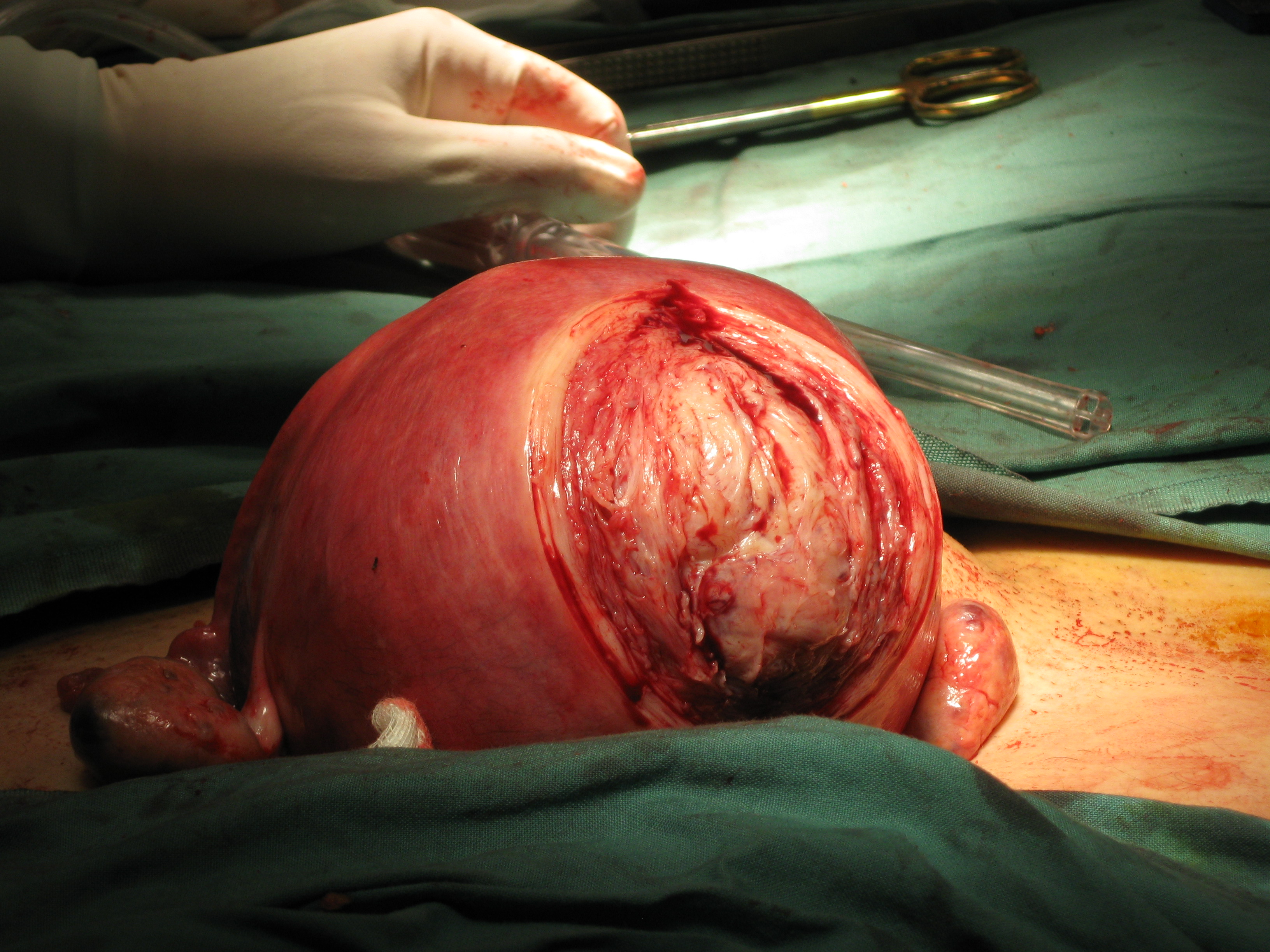 Myomectomy Posterior Wall Fibroid Myomectomy Posterior Wall Fibroid