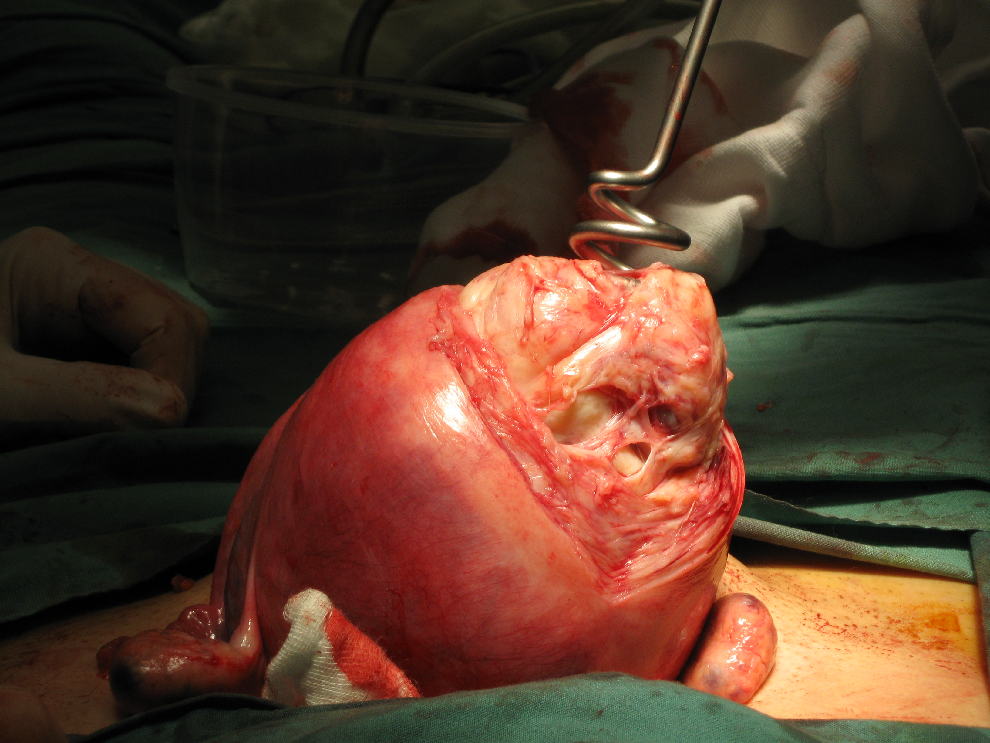 Fibroid Myomectomy Screw Posterior Wall Fibroid Myomectomy Screw Posterior Wall