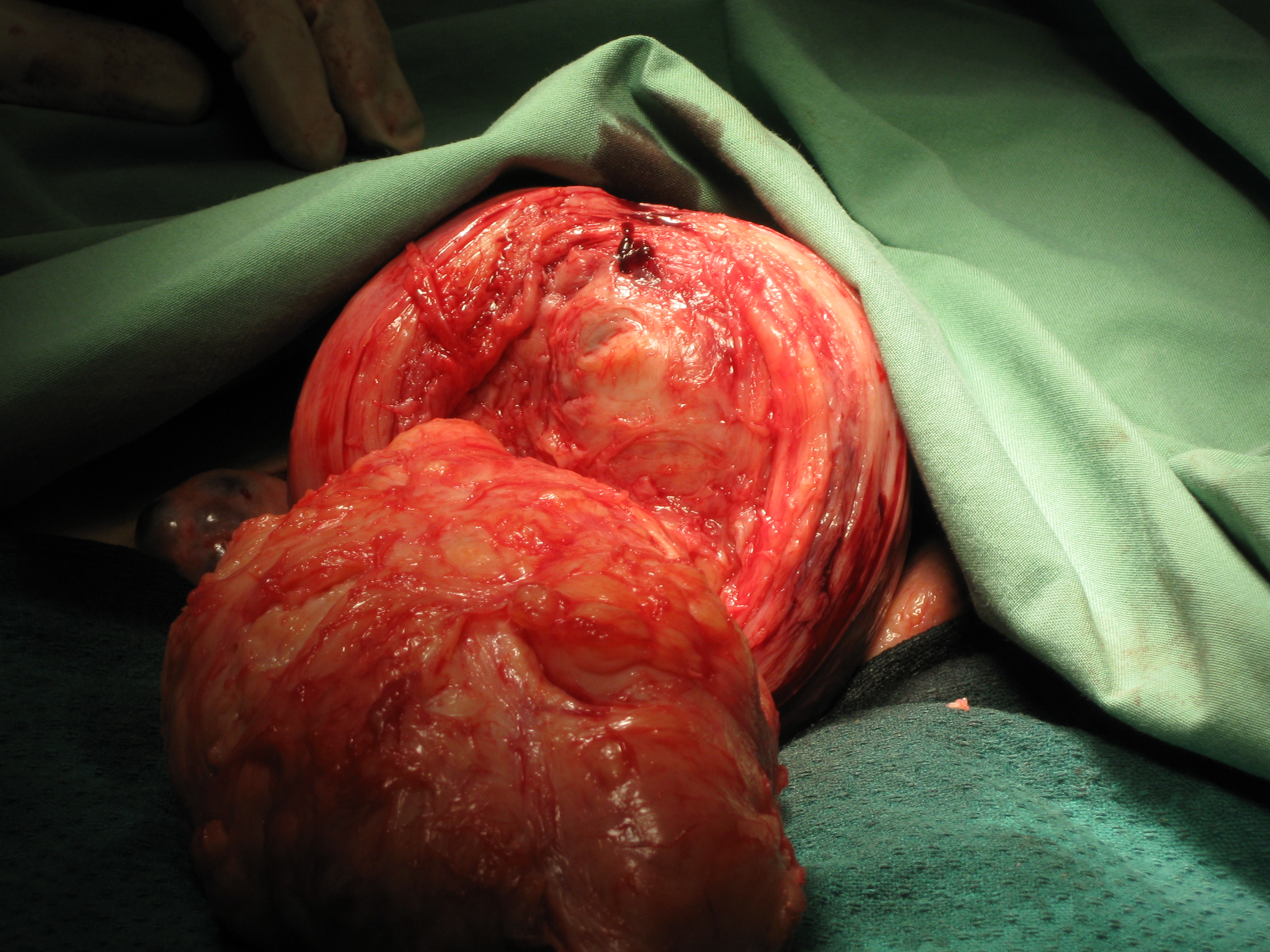 Myomectomy Fibroid Posterior Wall Myomectomy Fibroid Posterior Wall