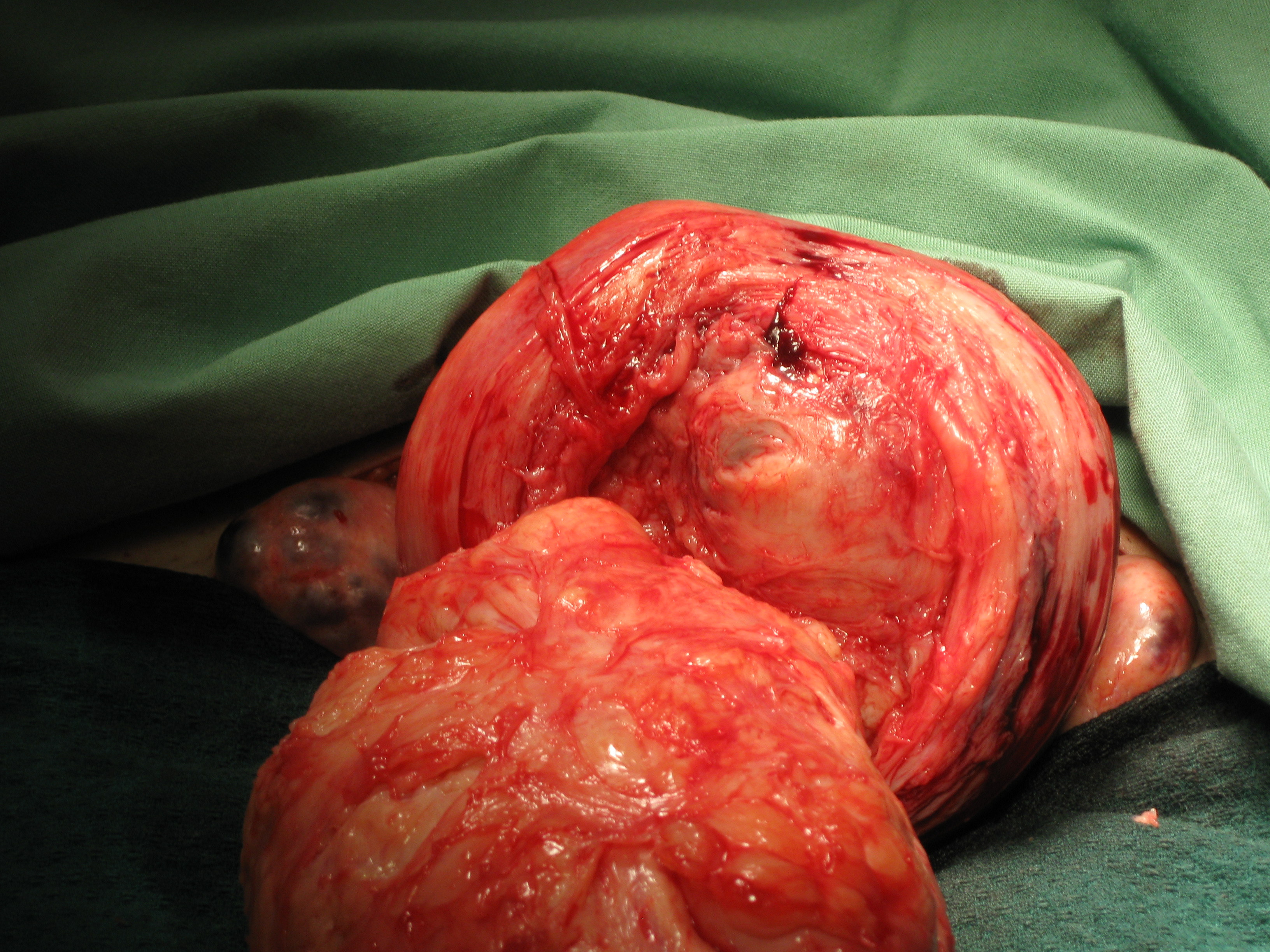 Myomectomy Fibroid Enucleation Myomectomy Fibroid Enucleation