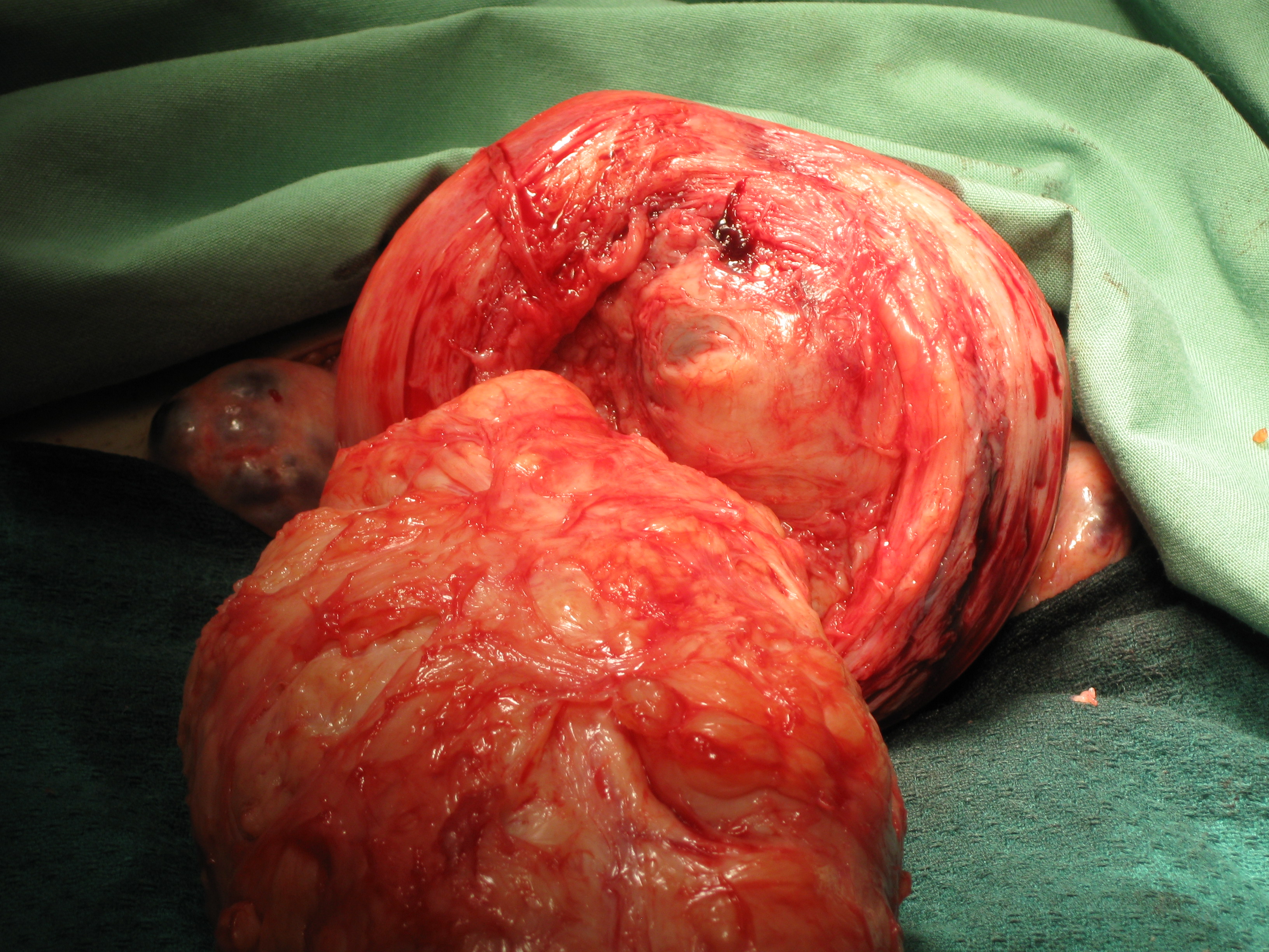 Myoma Large Myomectomy IVF Myoma Large Myomectomy IVF