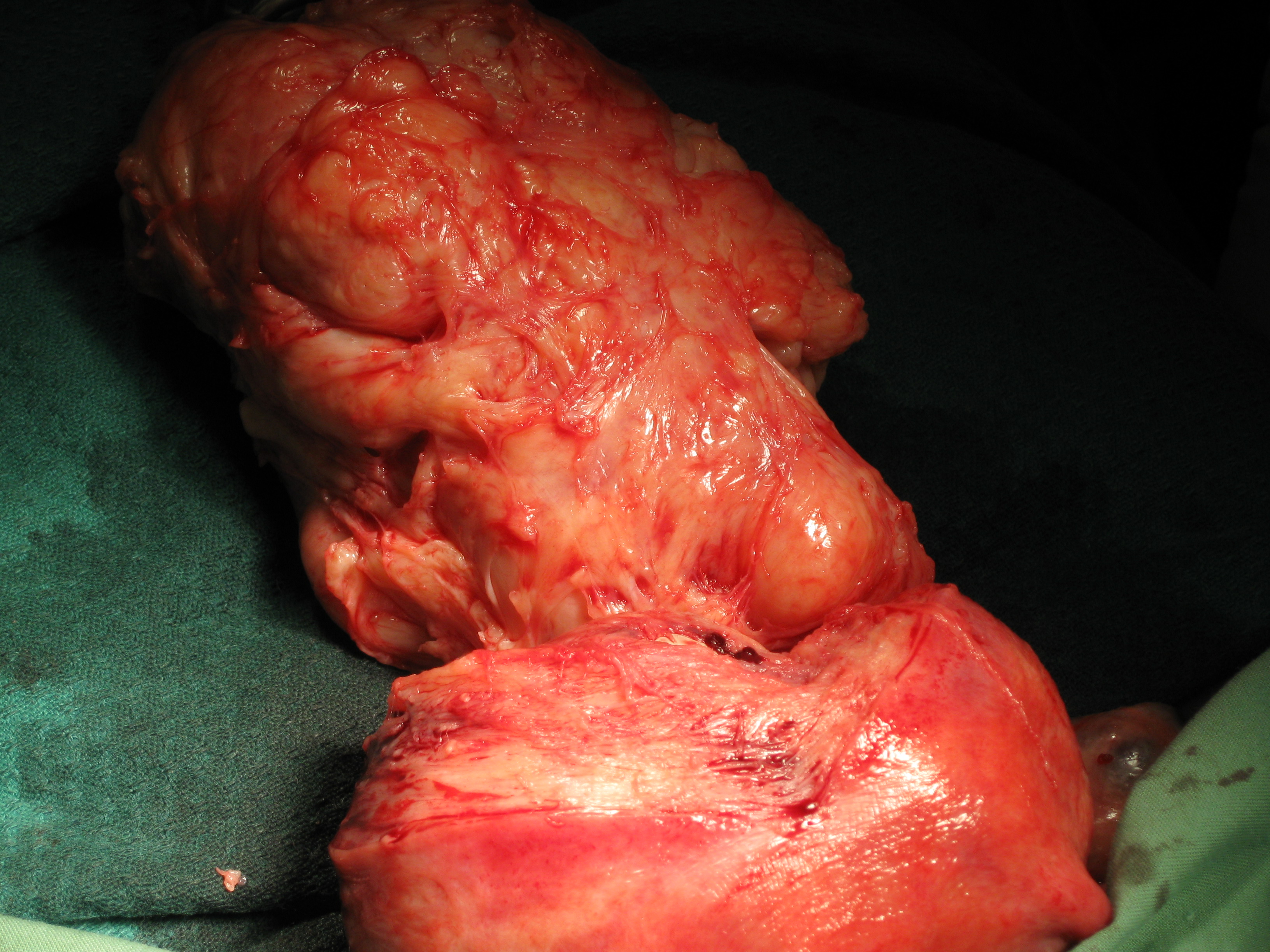 Myomectomy Fibroid Posterior Wall