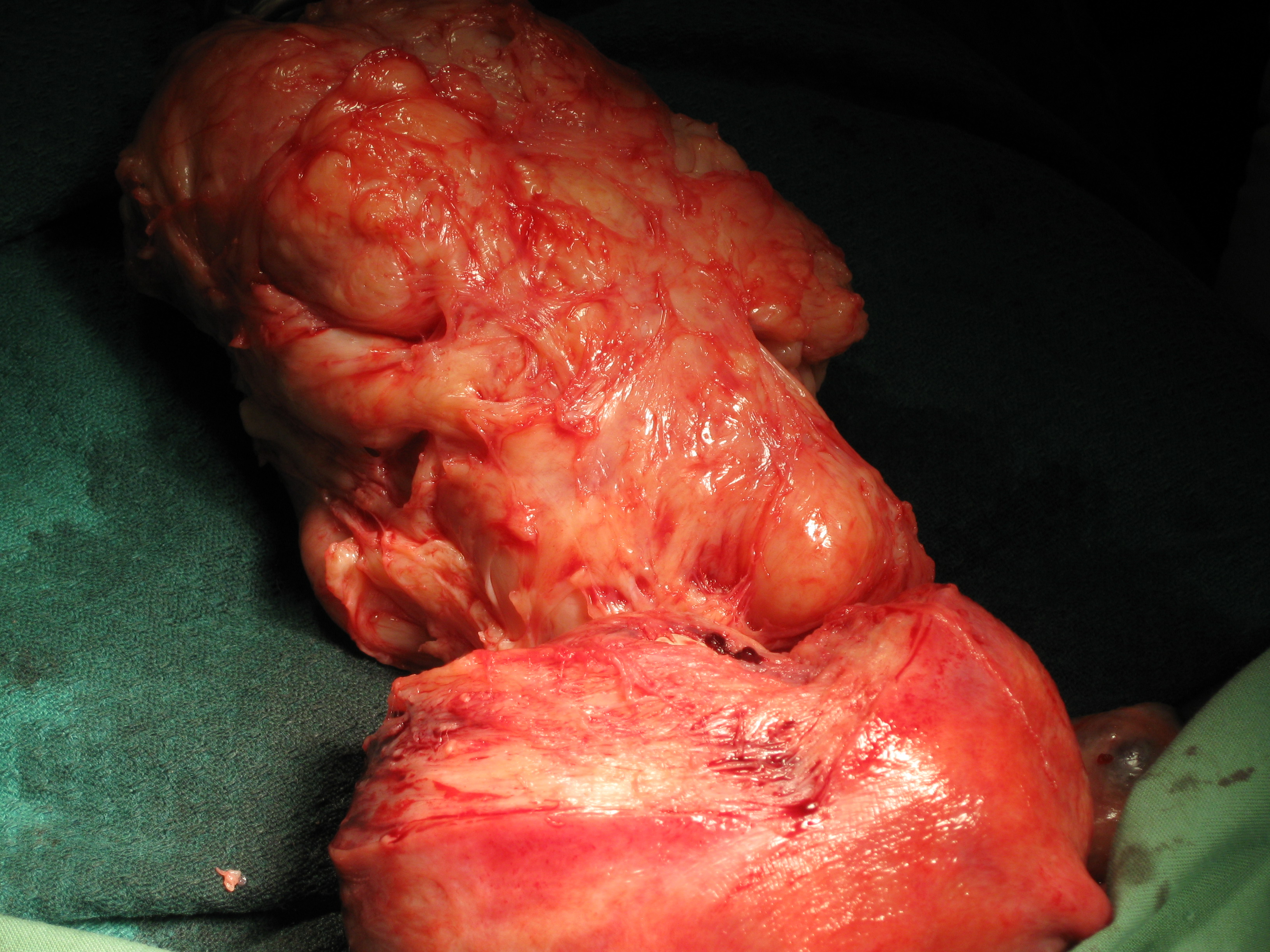Myomectomy Fibroid Posterior Wall Myomectomy Fibroid Posterior Wall