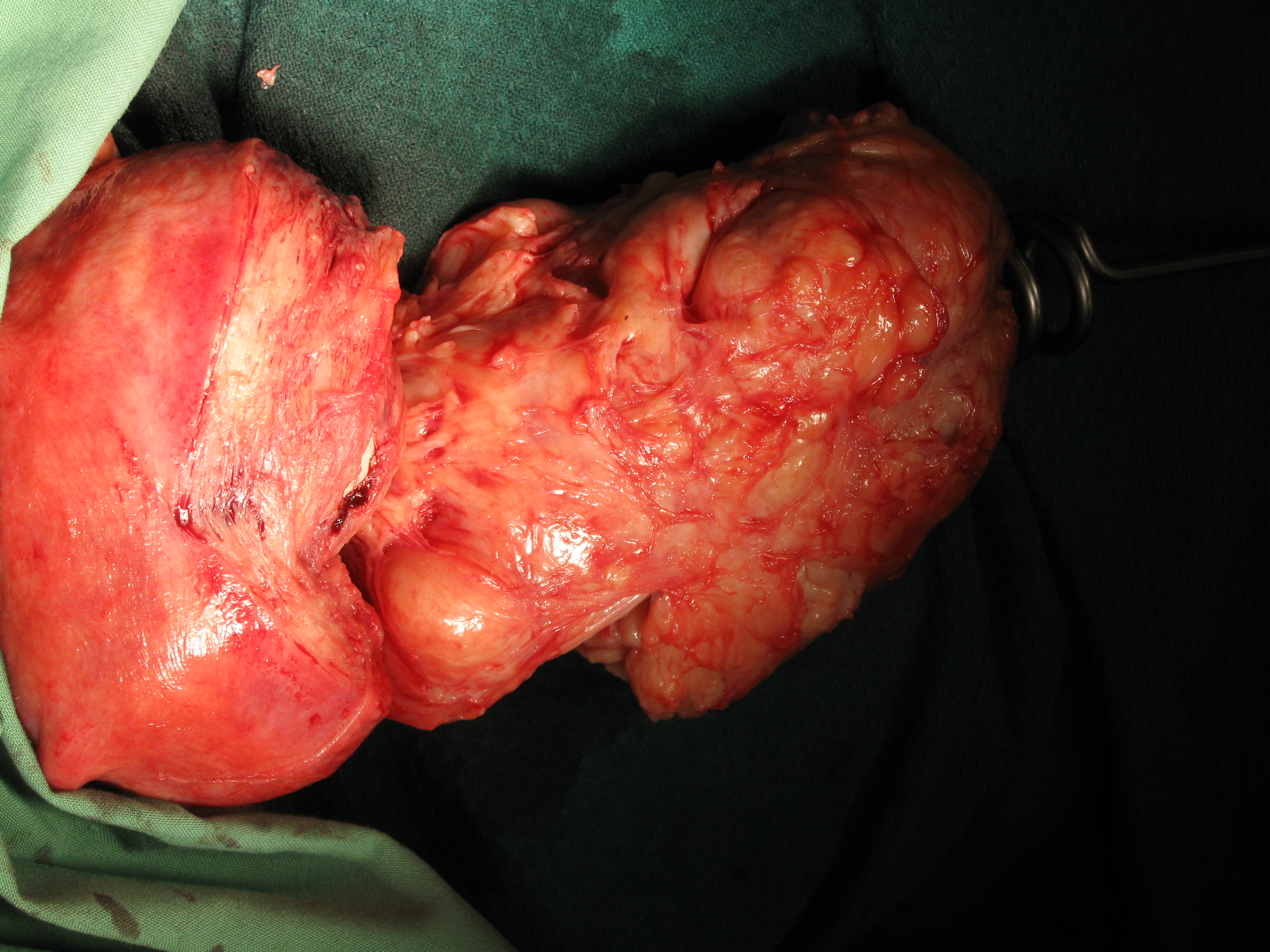 Myomectomy Fibroid Fertilty