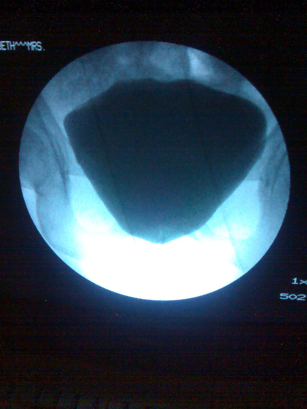 urethrocystogram incontinence youssif urethrocystogram incontinence youssif