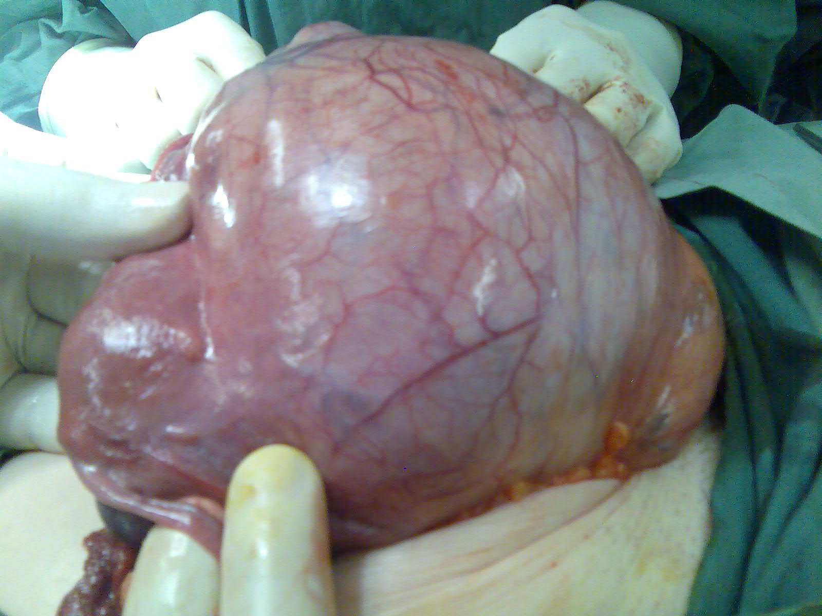fibroid cervix serag youssif