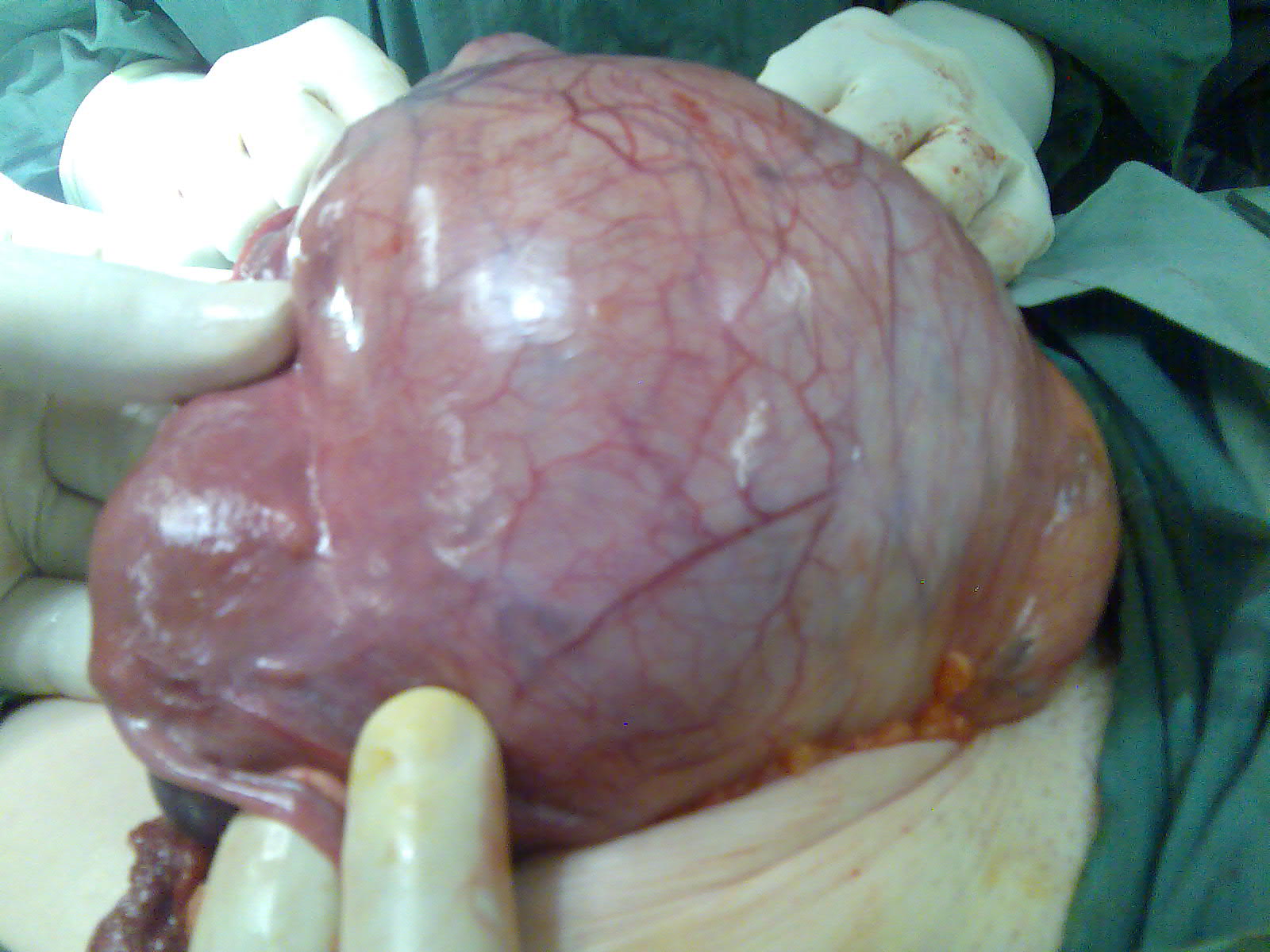 fibroid cervix serag youssif fibroid cervix serag youssif