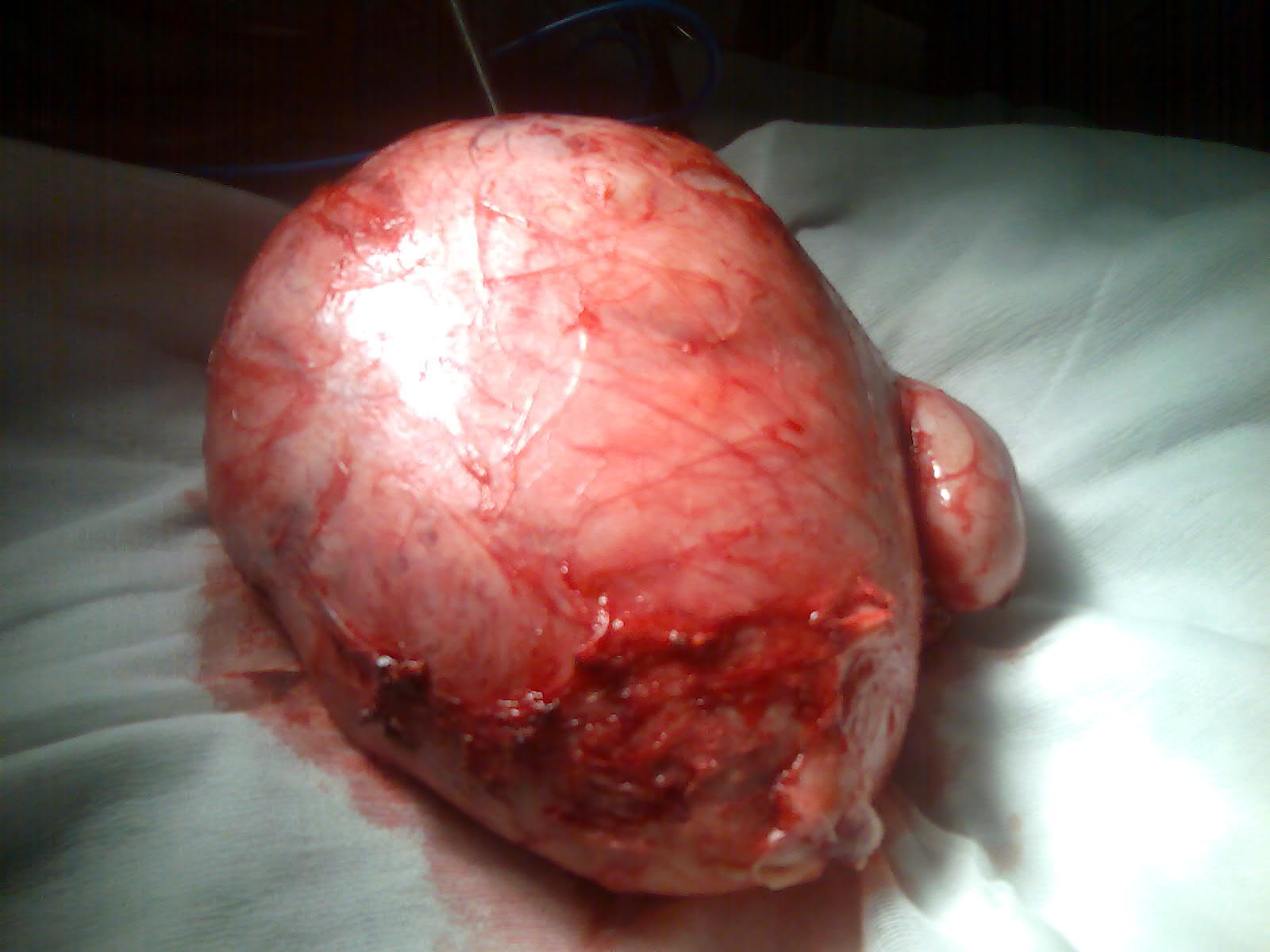 myomectomy cervical fibroid serag youssif myomectomy cervical fibroid serag youssif