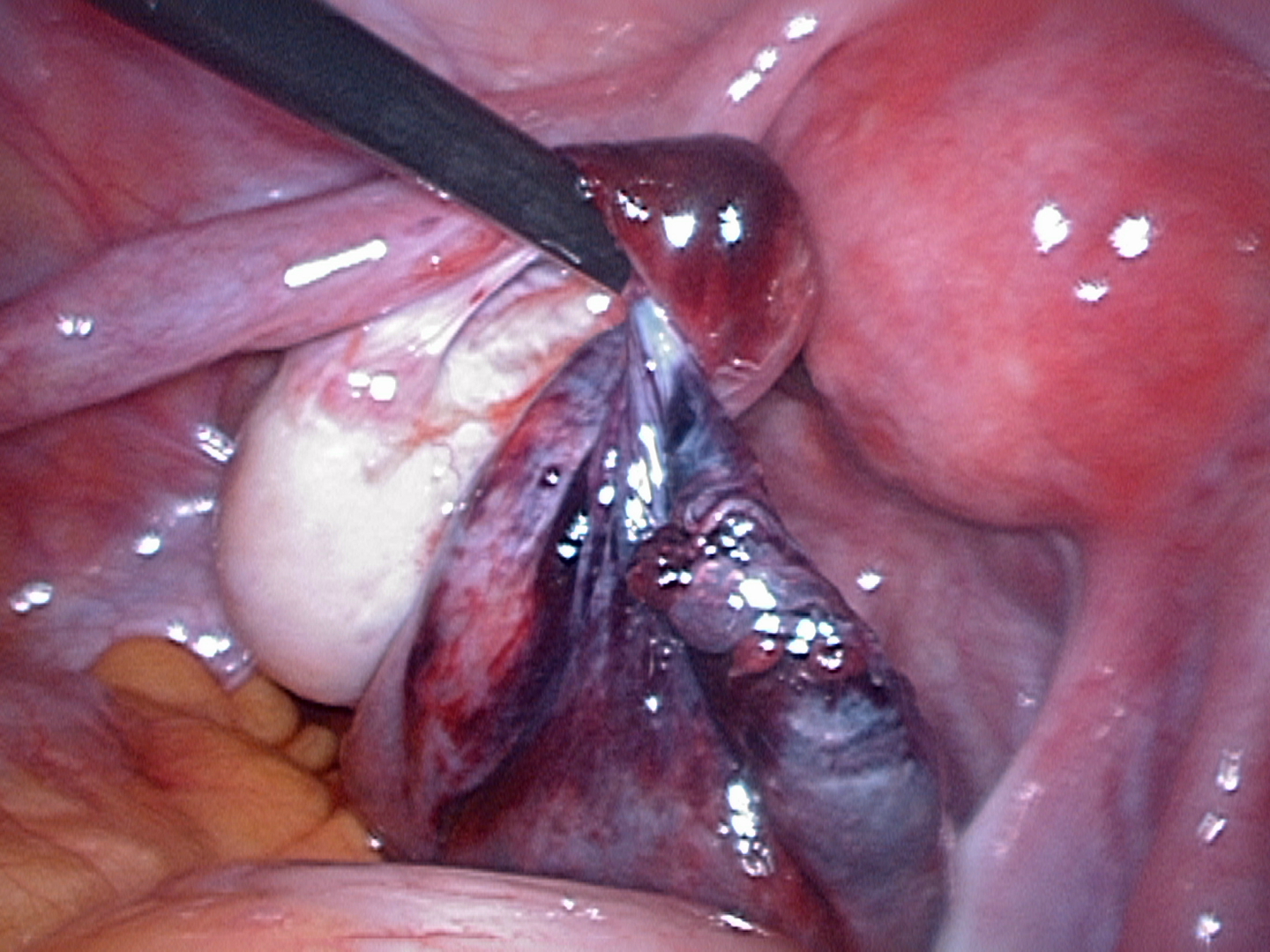 Twisted left fallopian tube normal left ovary