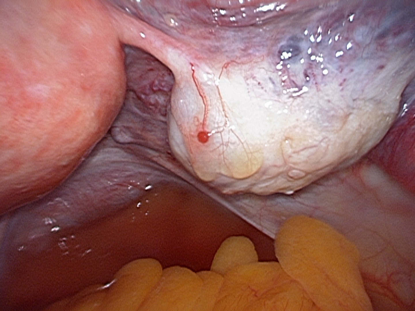 rigt-ovary-endometriosis