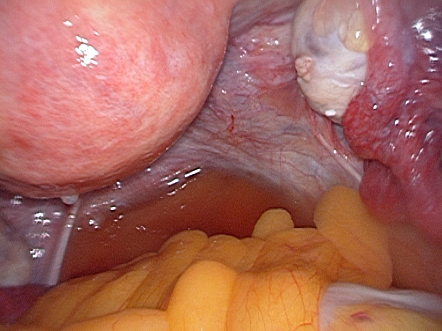 back of uterus-Pouch-of-douglas back of uterus-Pouch-of-douglas
