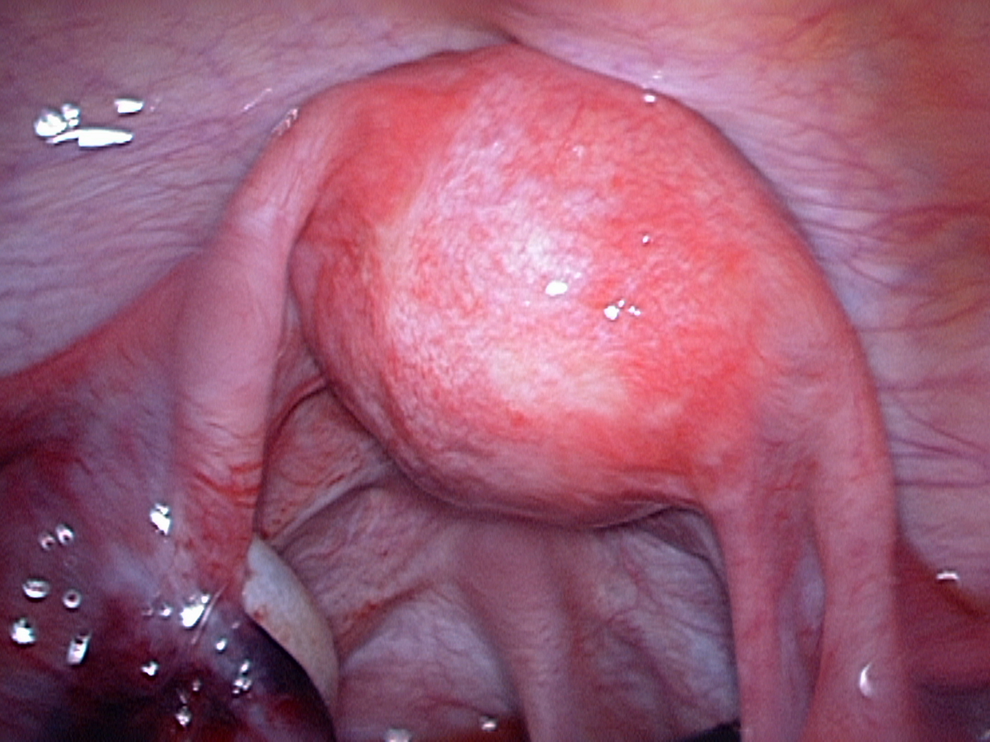Normal uterus Normal uterus