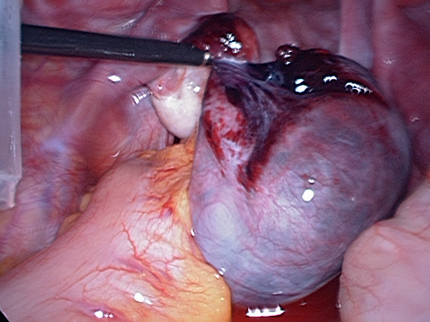 Twisted-left-fallopian-tube Twisted-left-fallopian-tube