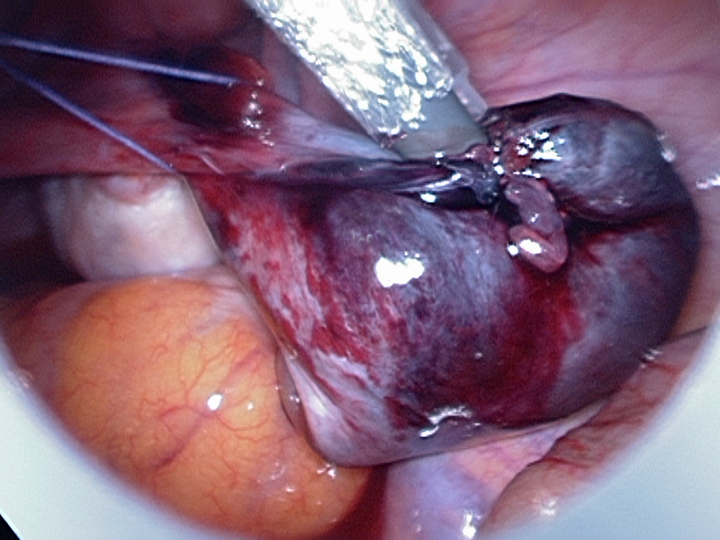 Applying suture loop around tube Applying suture loop around tube