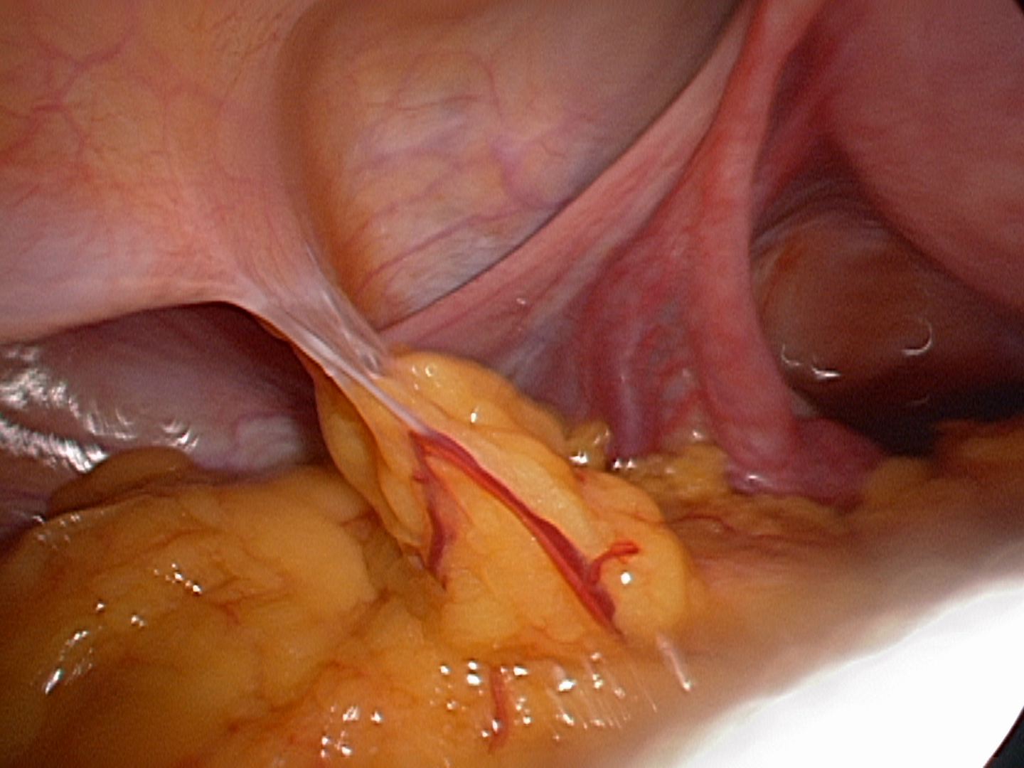 omental adhesions omental adhesions
