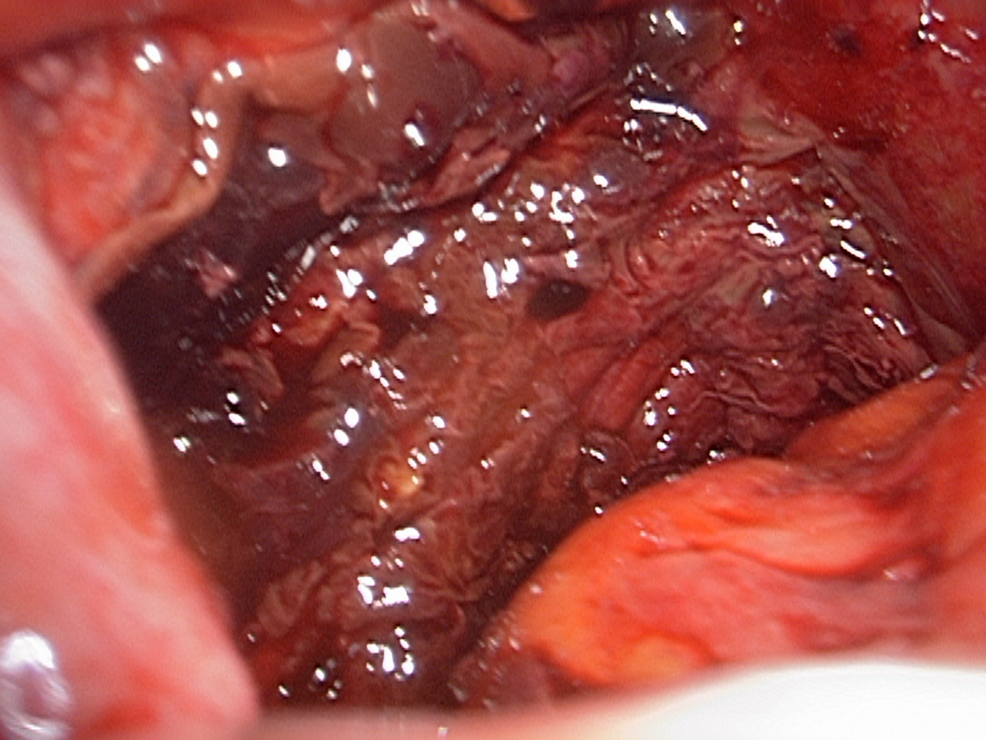 severe endometriosis between uterus and bowel