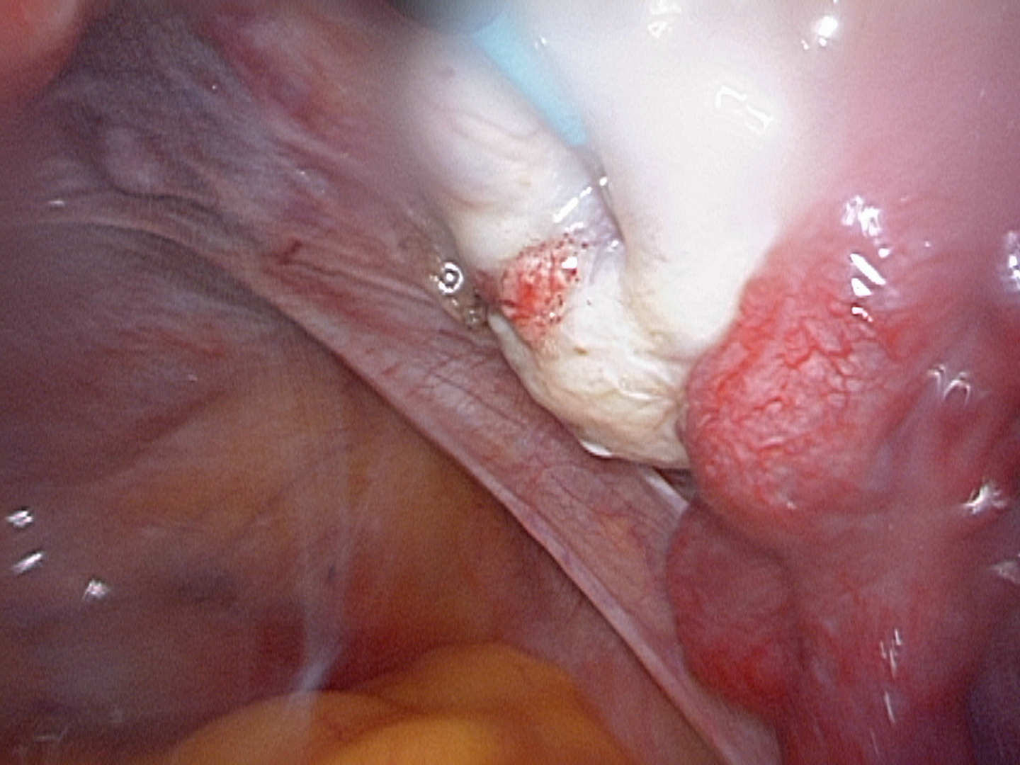 endometriosis ovary endometriosis ovary