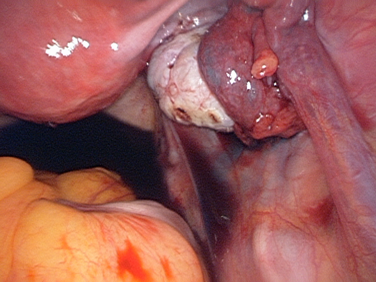 right-tube-blue-dye-passed right-tube-blue-dye-passed