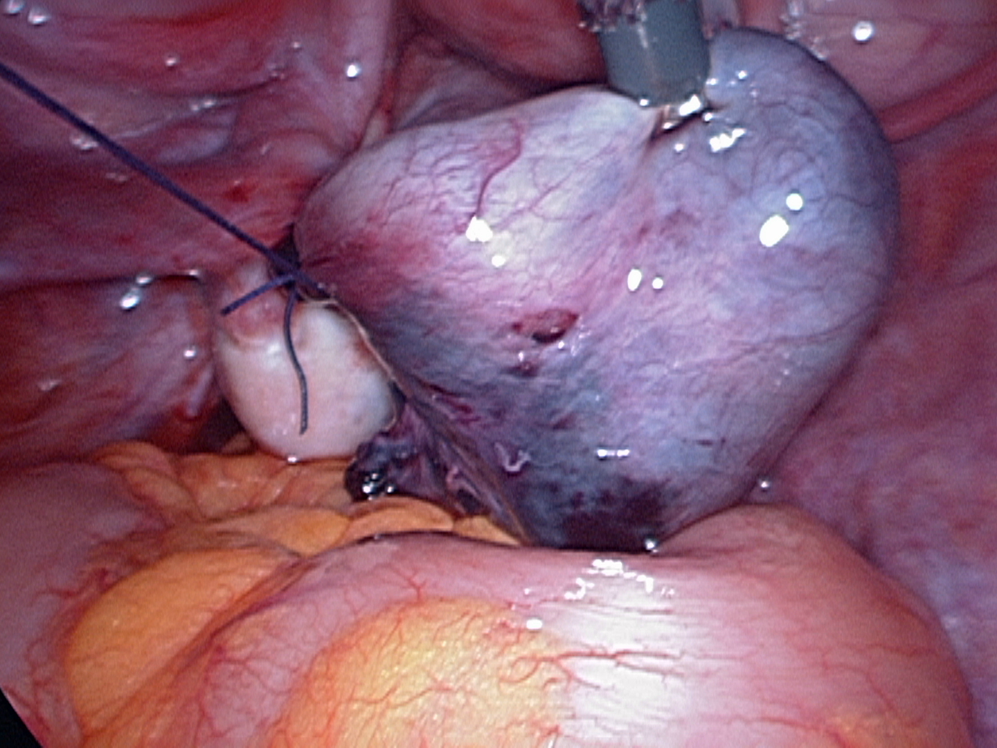 Tightining second endo loop around tube Tightining second endo loop around tube