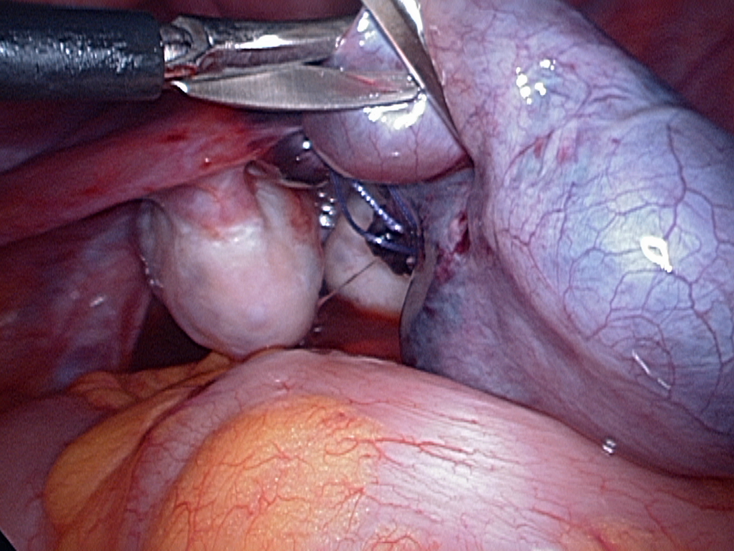 Cutting twisted tied fallopian tube Cutting twisted tied fallopian tube