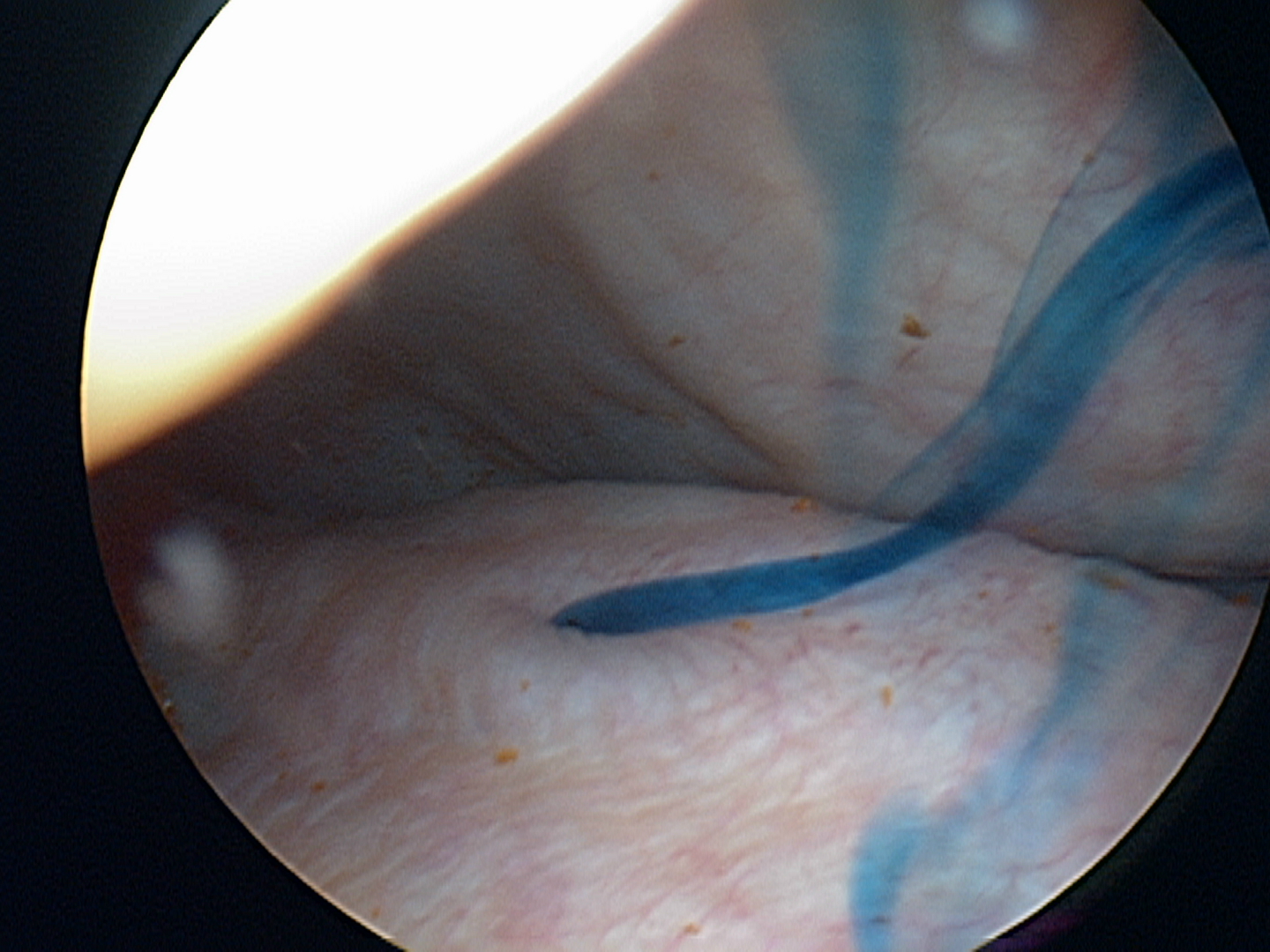blue dye to confirm patency of ureter blue dye to confirm patency of ureter