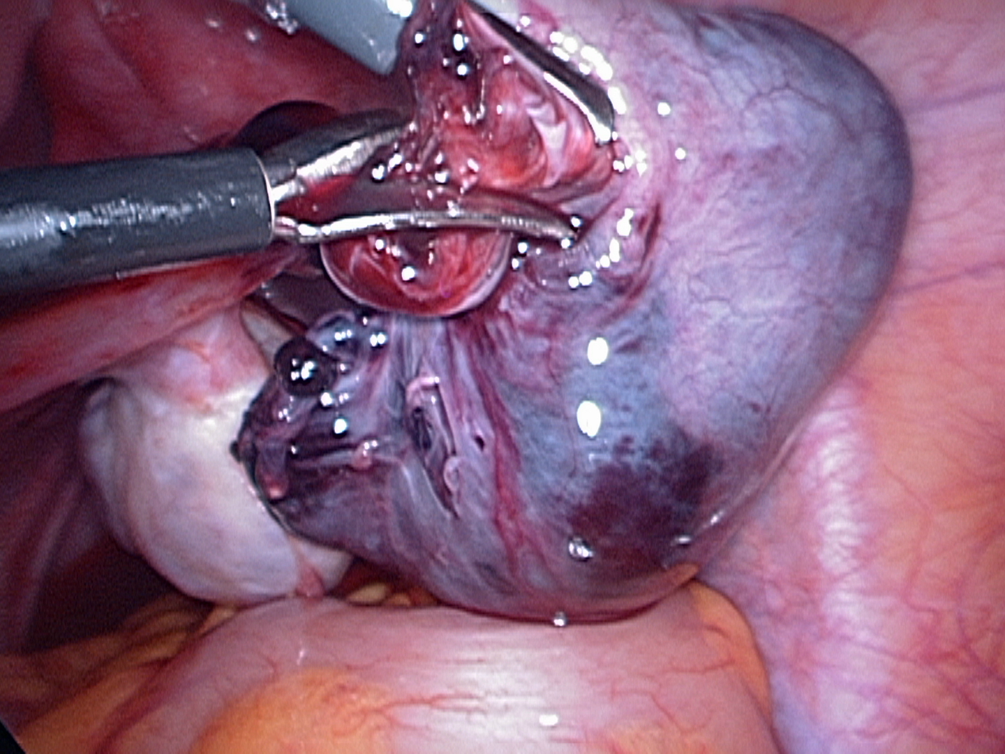 separating necrotic fallopian tube separating necrotic fallopian tube