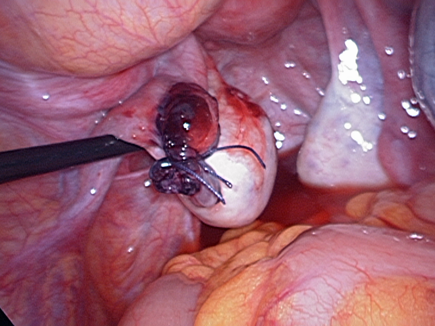 ovary after removing torted tube ovary after removing torted tube
