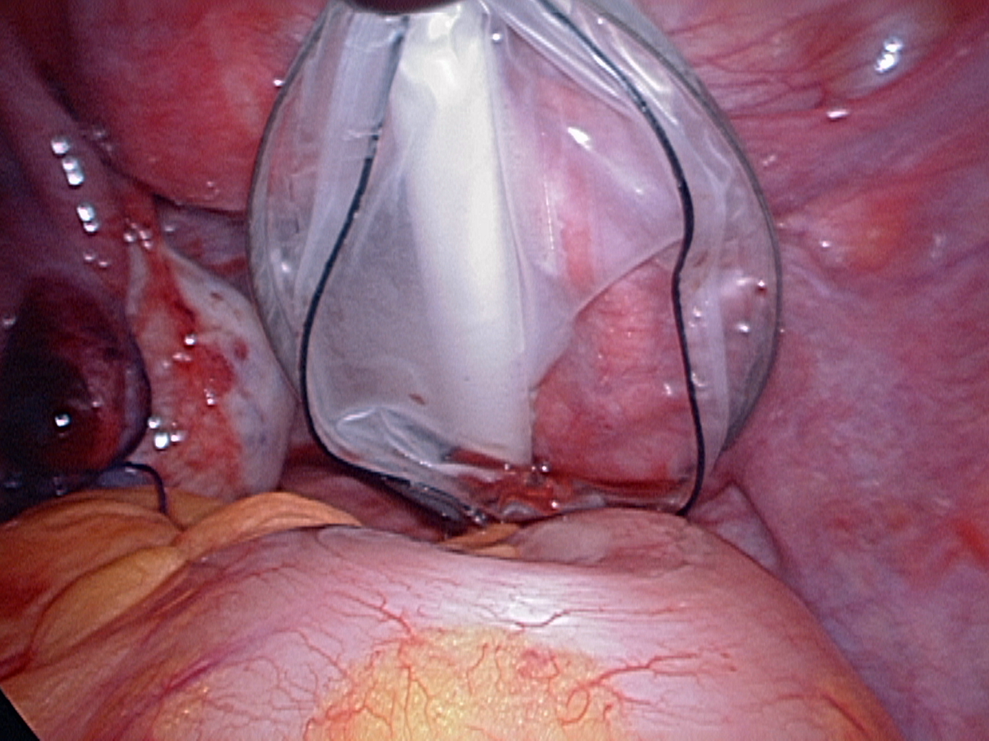 Endopouch to remove twisted-fallopian tube Endopouch to remove twisted-fallopian tube