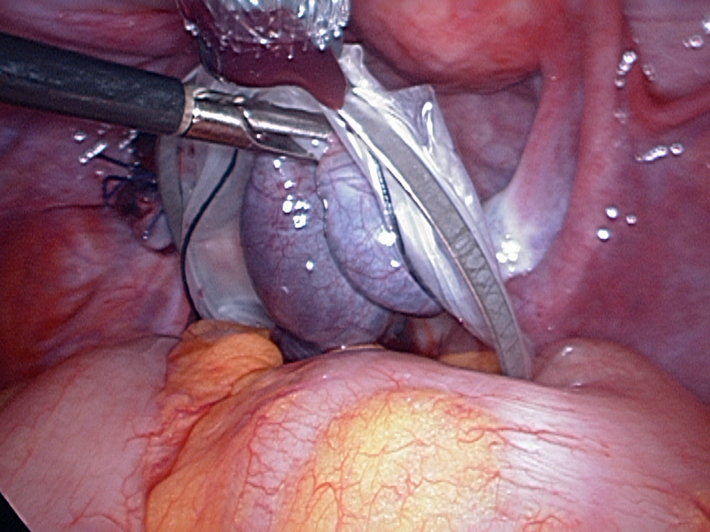necrotic torted tube in endobag necrotic torted tube in endobag